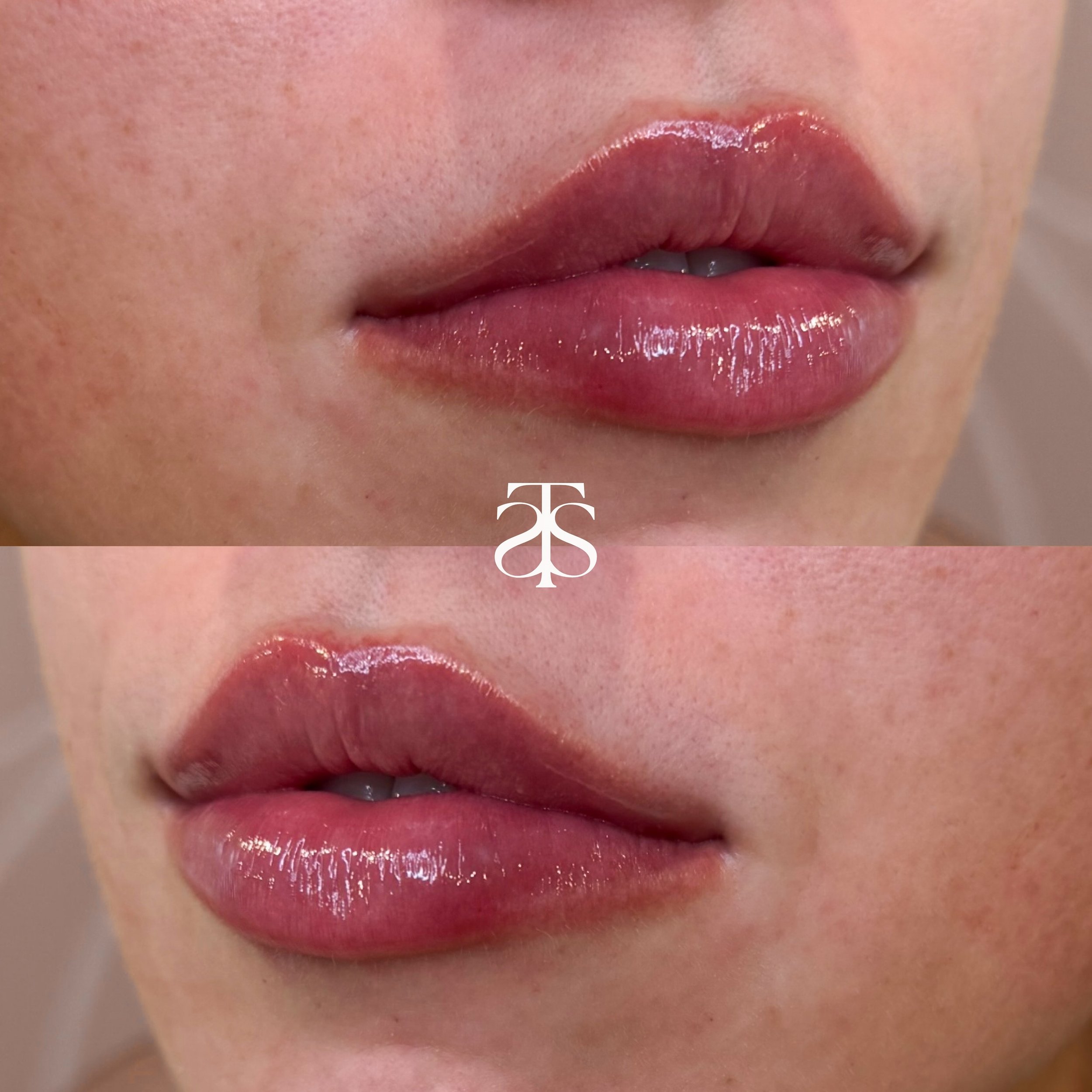✨Top Lip filler questions✨

💫What are lip fillers made of?
Lip fillers are made of hyaluronic acid, which is a naturally occurring substance in the body. Hyaluronic acid fillers work by retaining moisture in the skin to increase the volume, shape an