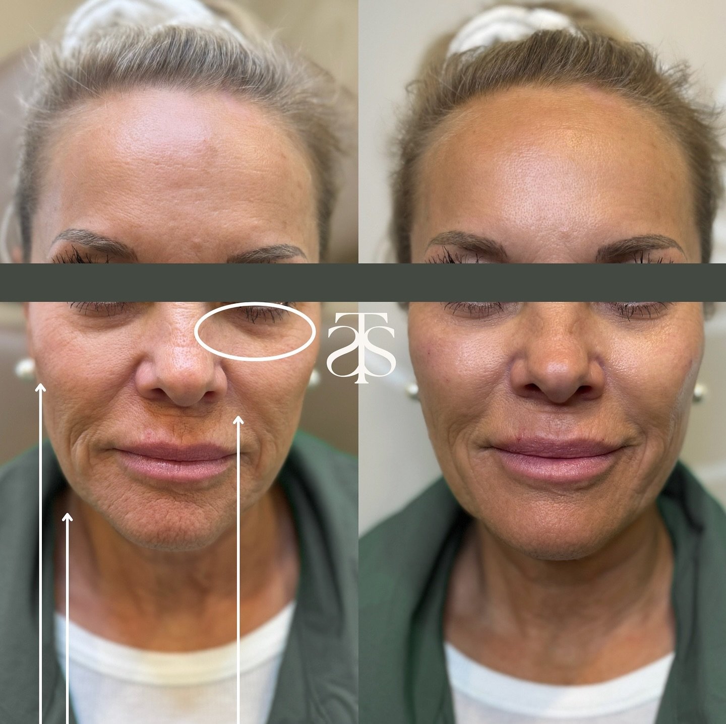 💉Cheek filler checklist:

✔️Volume restoration 
✔️Soften under eye hallows 
✔️Lift jowels
✔️Lift and diminish nasolabial folds (smile lines)
✔️A beautiful and subtle enhancement for a more youthful appearance ￼