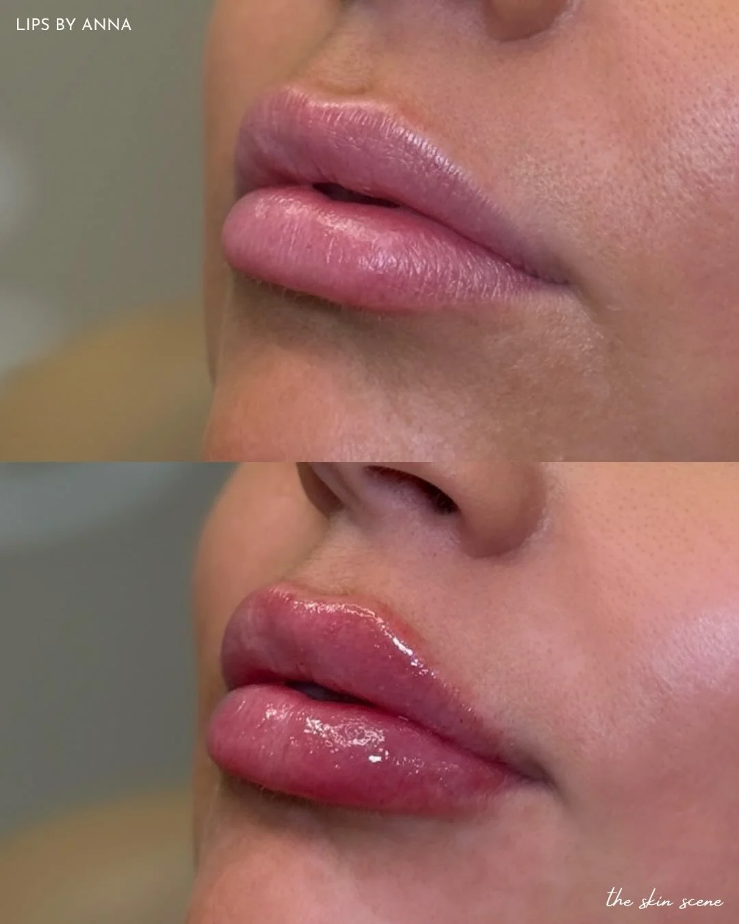 Lip filler is a journey, not a single appointment 🤍

This result was built slowly with touch-ups over two years and close to 3 syringes total, allowing us to refine shape and volume while keeping everything natural and balanced.

First slide: mainte