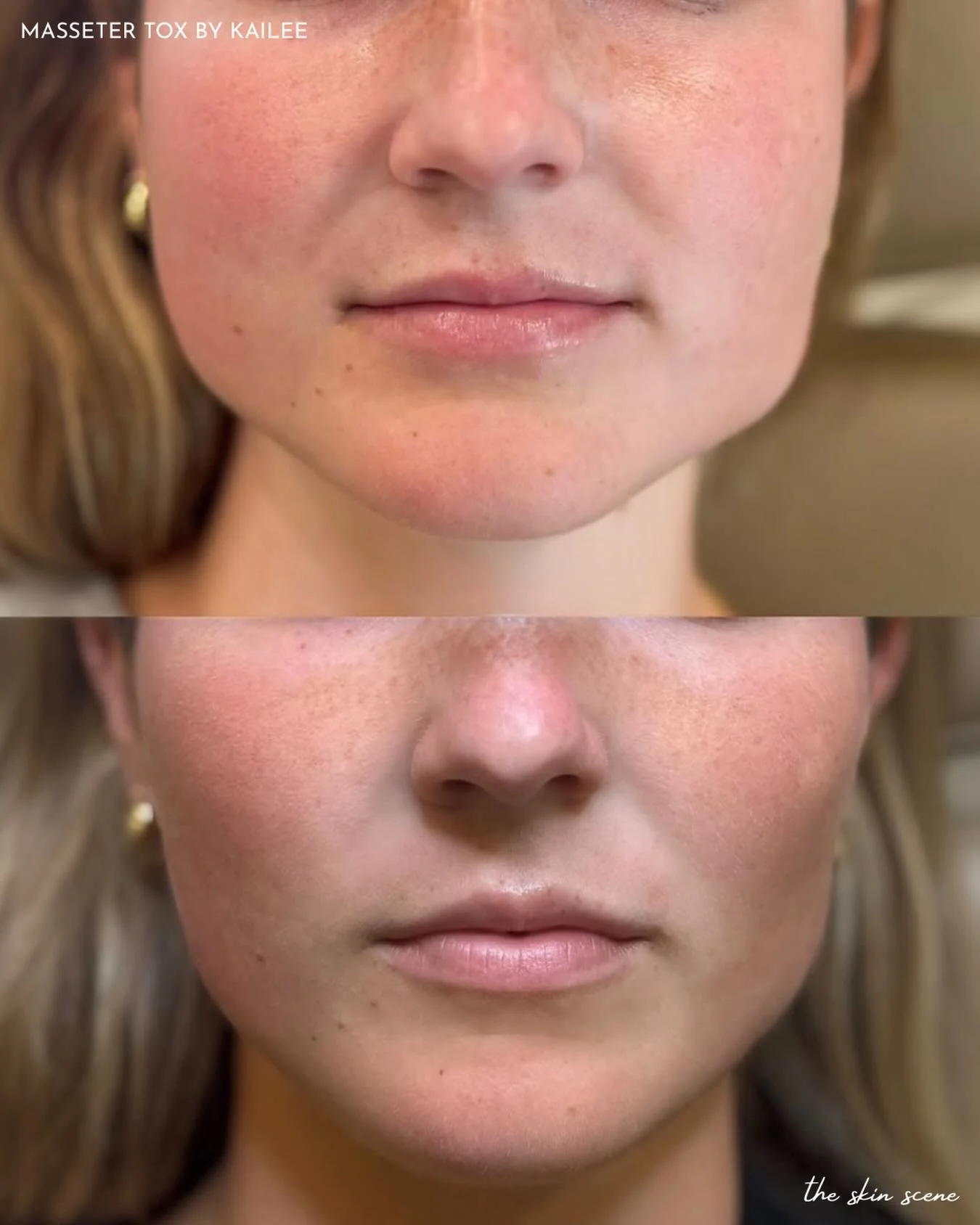Overworked jaw muscles from clenching or grinding can become enlarged and cause tension or a wider lower face.

Masseter tox can help:
✨ Reduce clenching &amp; grinding
✨ Ease jaw/TMJ discomfort
✨ Slim and soften the jawline

Quick treatment, minimal