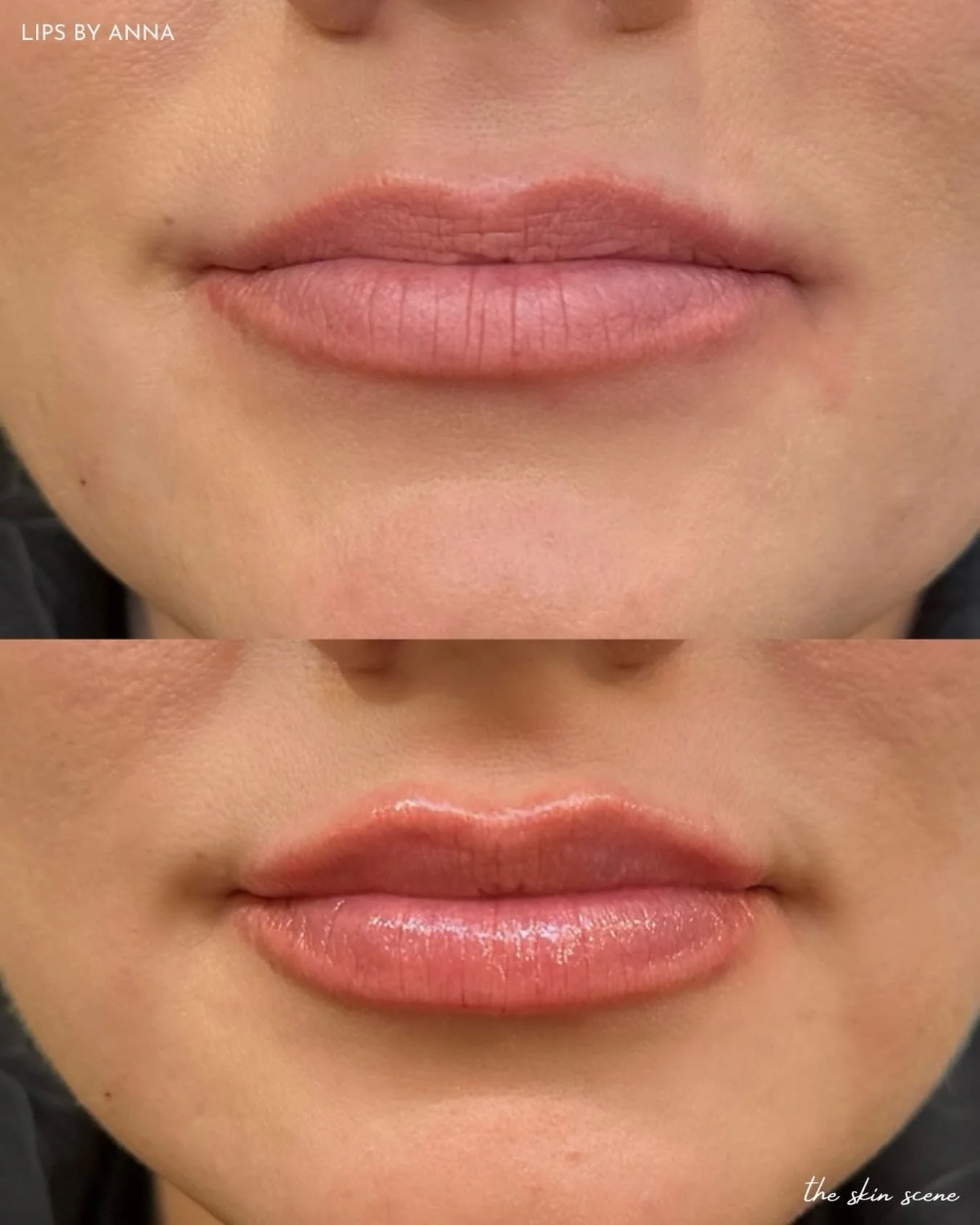 Precision matters 💉
This result was achieved by Nurse Injector Anna with half a syringe of kysse, focusing on upper lip definition and structure while maintaining a natural appearance.

🤍 Interested in subtle, tailored results? Book a consultation 