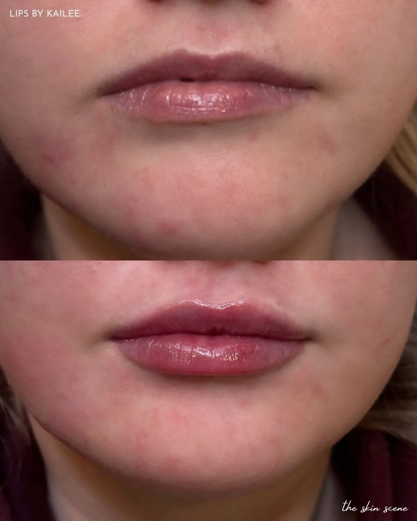 Before &amp; after. Lip filler is never one-size-fits-all. For our lovely client, Kailee focused on improving lower lip symmetry and overall balance while preserving a natural, refined shape. Every treatment plan is tailored to the individual&mdash;b