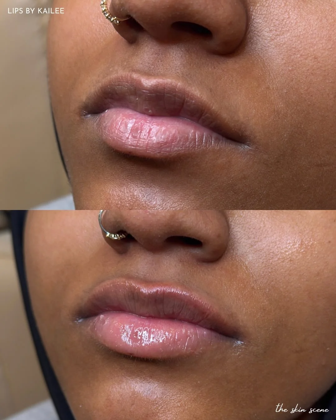 Today&rsquo;s before &amp; after.
Subtle hydration. Soft definition. Natural balance.
Injected by @injectorkails_rn 🤍

#lipfillermn #fillermn #medspamn #nurseinjector #sculptramn
