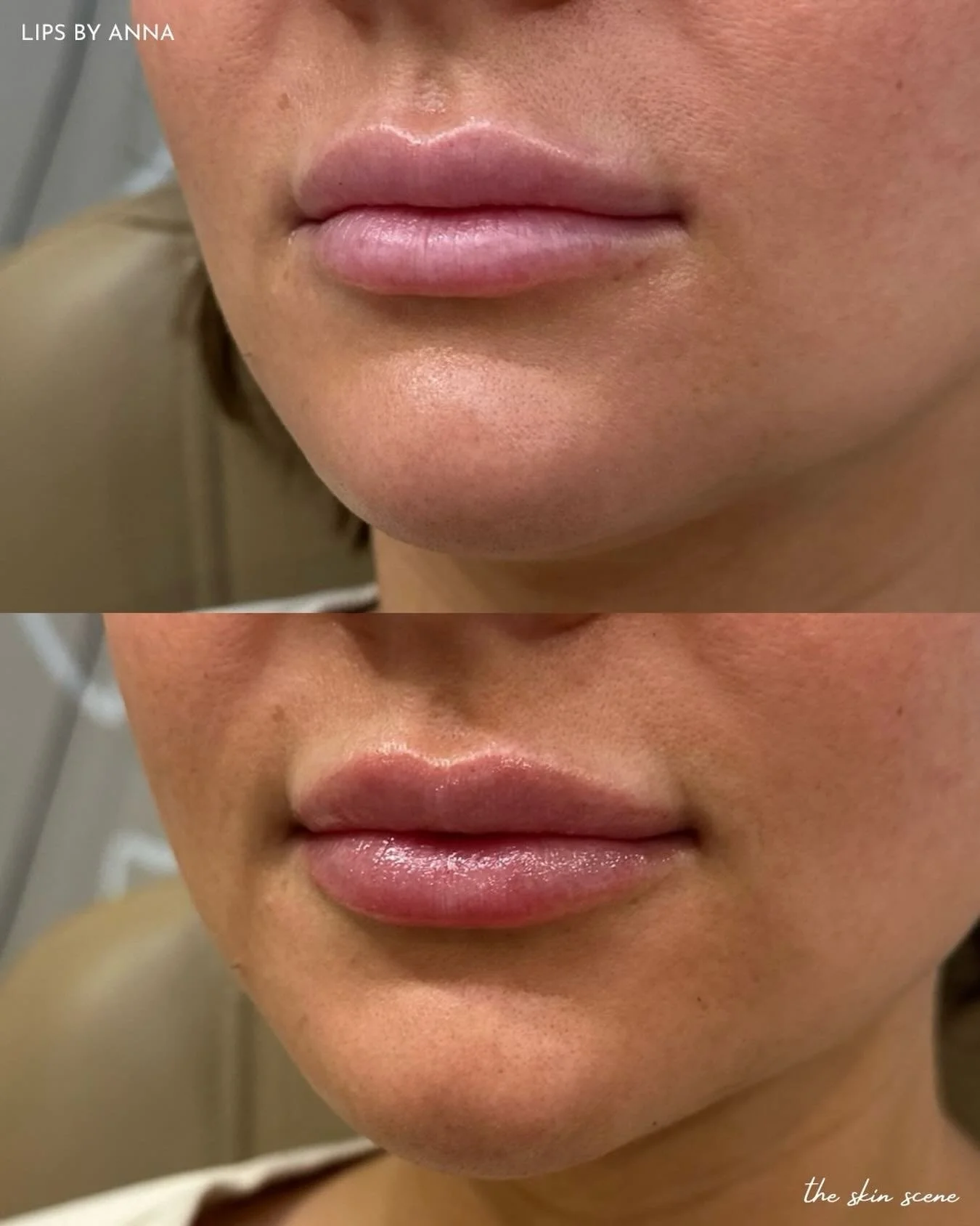 Sometimes the smallest adjustments create the most beautiful results. Injector Anna worked carefully to improve the symmetry of these lips while maintaining a natural, balanced look.

Thinking about lip filler?
Schedule your appointment with Anna tod