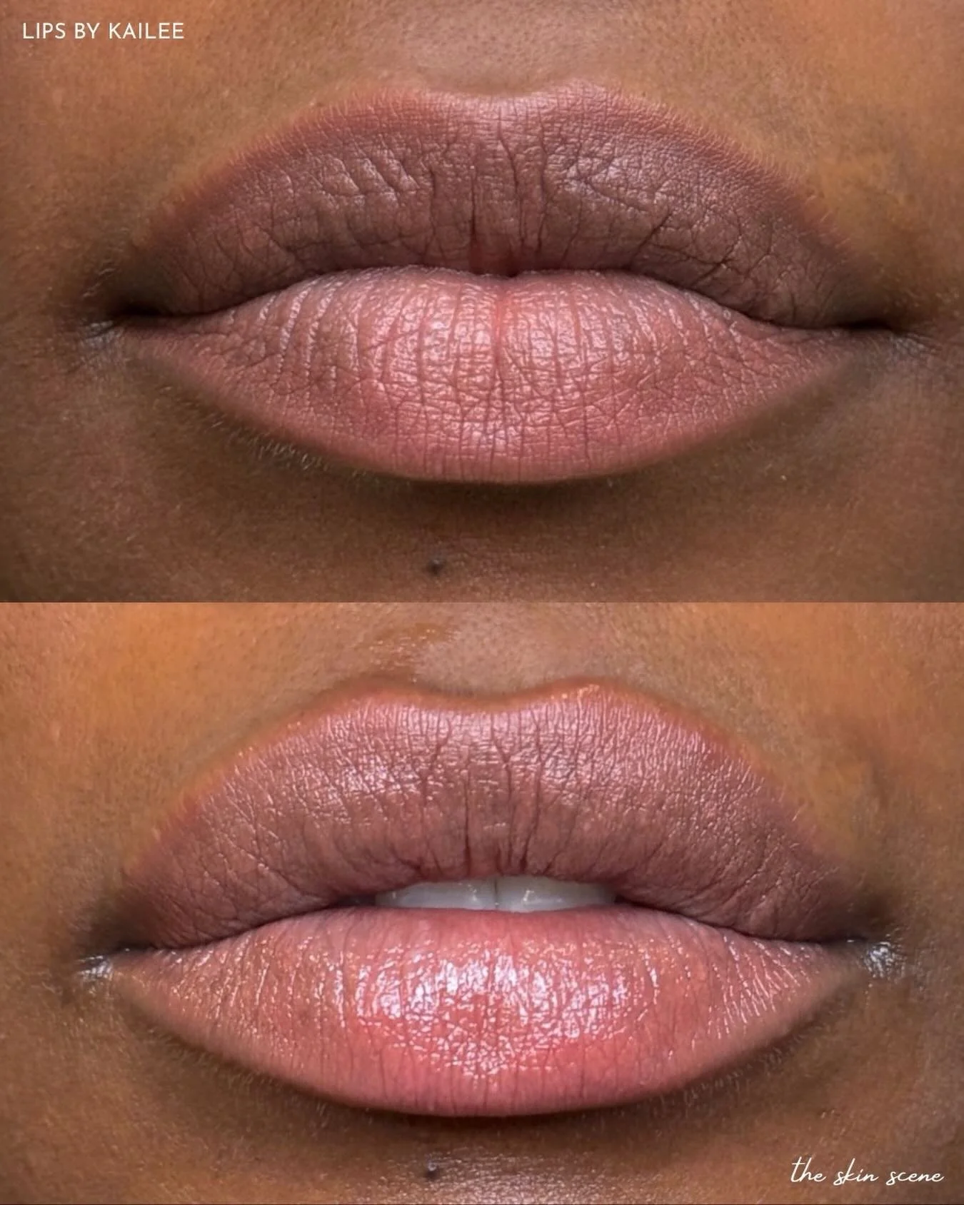 First session &rarr; 3 week follow-up ✨ 

At her follow-up appointment we added 0.6 mL to enhance hydration and gently refine the shape she was hoping for. 

Notice the difference in smoothness, hydration, and soft definition while still keeping the 