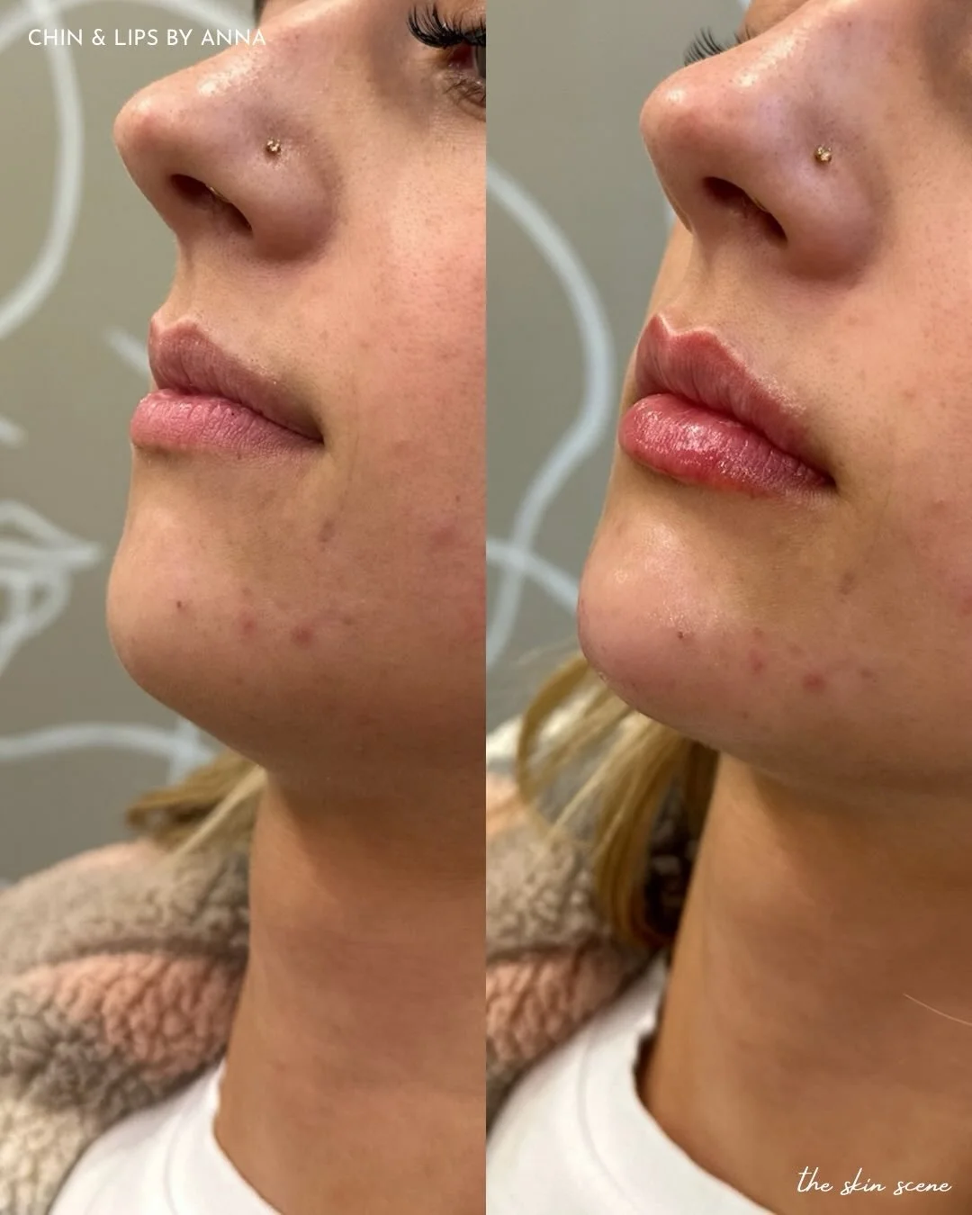 She came in wanting a crisp cupid&rsquo;s bow + more hydration 👄

Anna used 0.3 mL of RHA 2 to subtly define the lips and balance the bottom lip to match the top &mdash; keeping results natural yet refined.

For overall facial balancing, we paired t