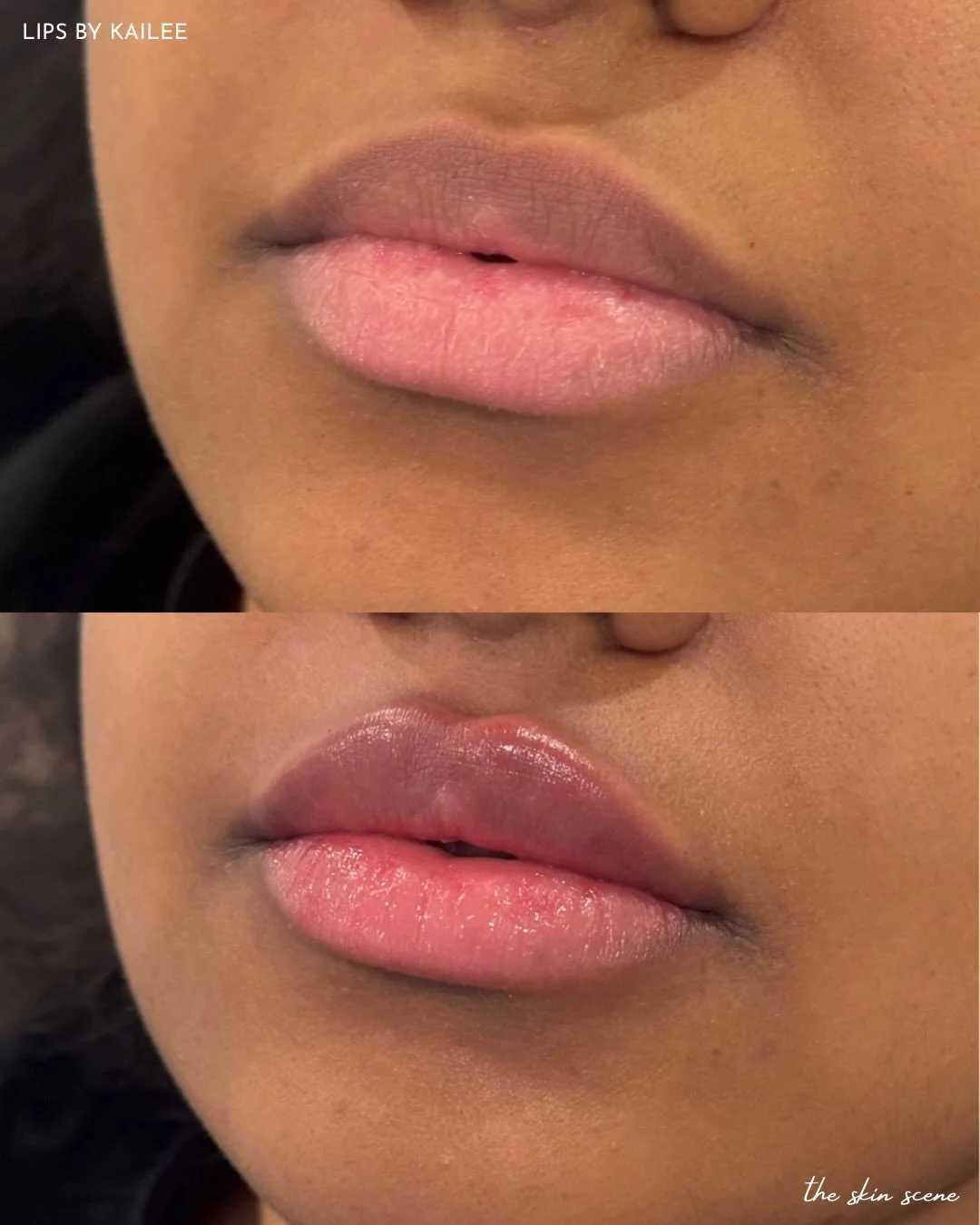 not too much. just enough.🤌😍💉 @injectorkails_rn

#lipfiller #minnesota #medspa #nurseinjector #edina