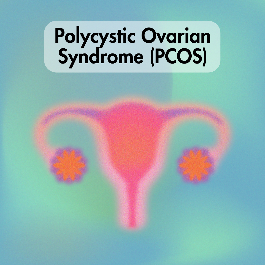 Managing Polycystic Ovarian Syndrome (PCOS)