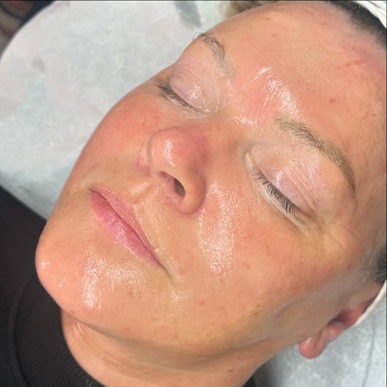 Post hydro jelly mask 🫧💕

&bull; Steam
&bull; Deep cleanse 
&bull; Gentle exfoliate 
&bull; Extractions 
&bull; Jelly mask
&bull; Scalp massage 
&bull; Jade eye mask 
&bull; Facial massage 
&bull; Moisturiser &amp; SPF

📍 Halifax | LRA