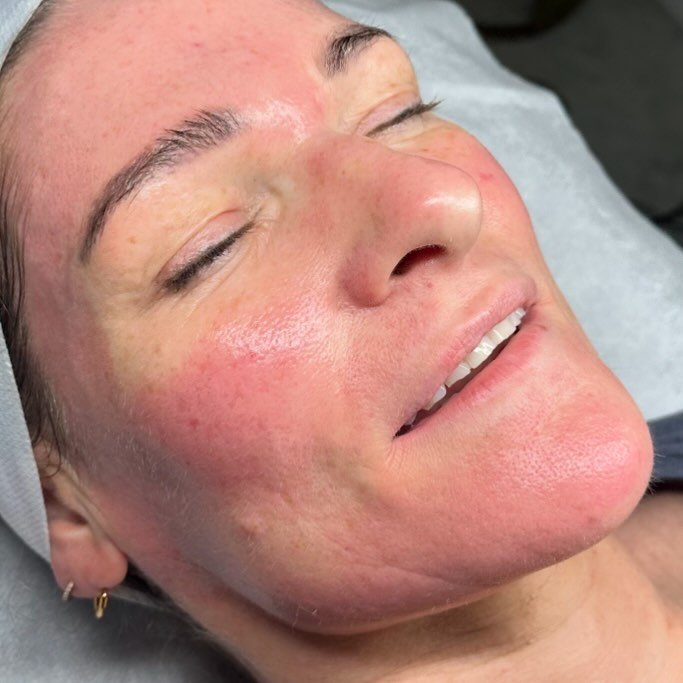 Want to boost collagen, improve texture, reduce scars, and rejuvenate your skin?

Microneedling is the treatment for you! Recommended every 4&ndash;6 weeks for noticeable results! It instantly makes skin feel tighter and more plum, giving you a gorge