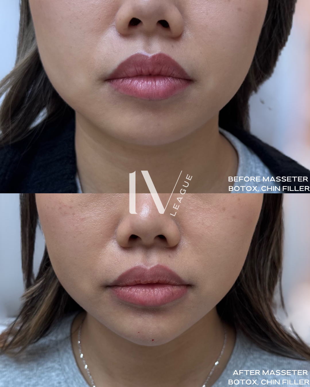 Chin filler, Masseter Botox jaw slimming treatment by Vicki Nguyen at Six Clinic Vancouver for facial contouring