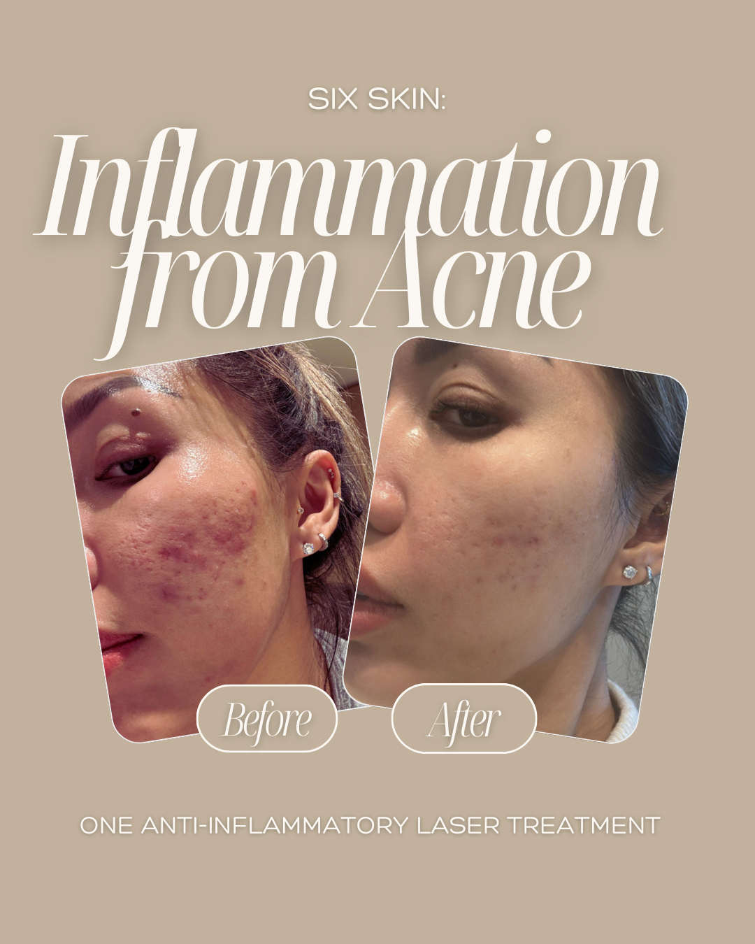 Inflammation Acne 