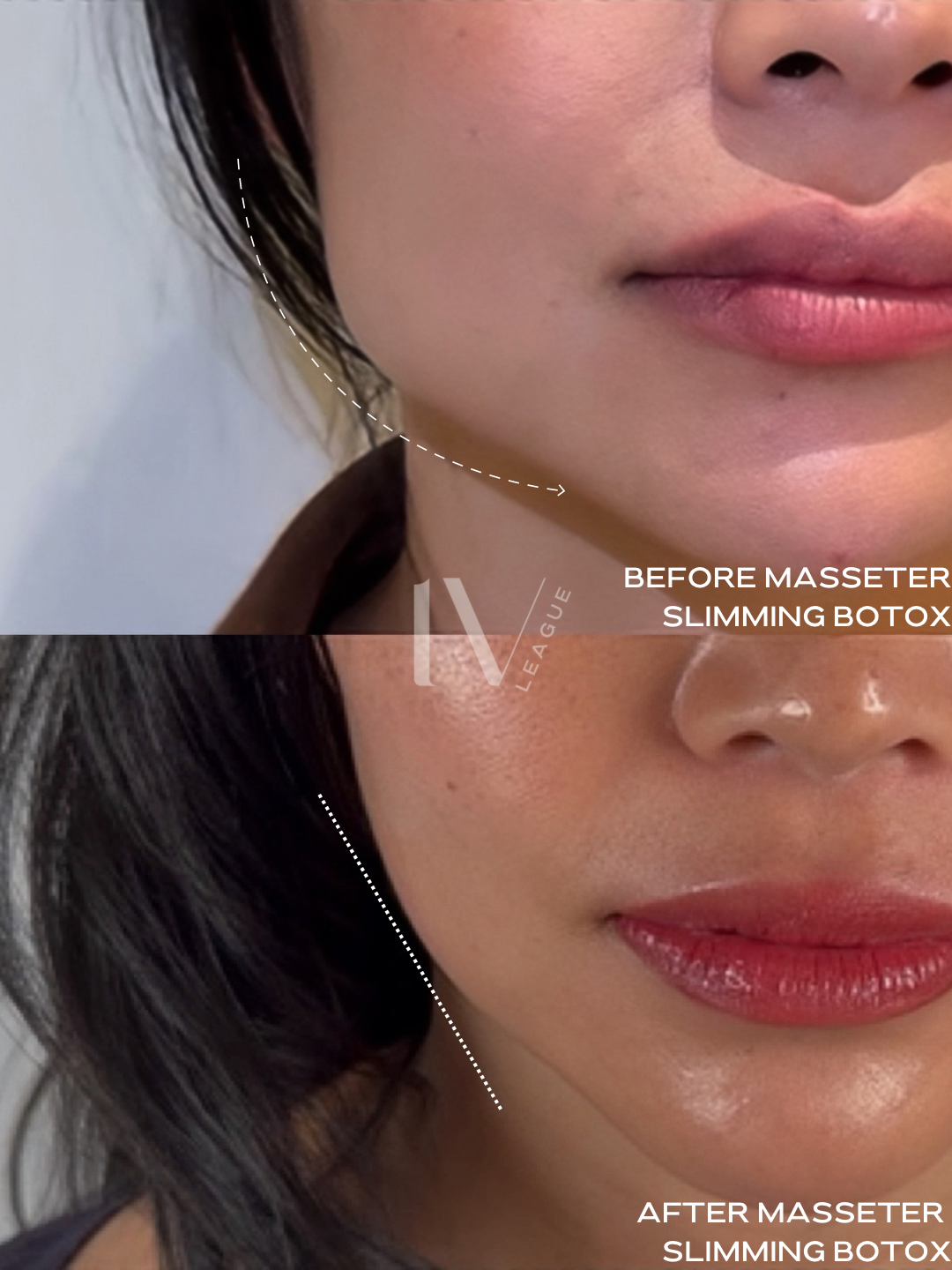 Masseter Botox jaw slimming treatment by Vicki Nguyen at Six Clinic Vancouver for facial contouring