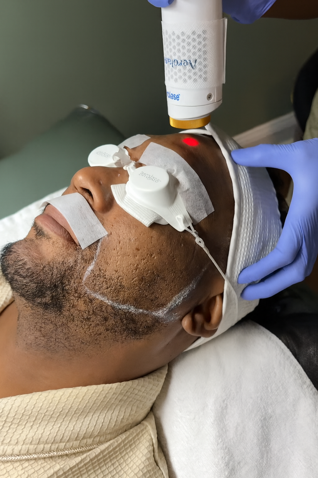 Aerolase Laser Treatment in Progress 2.png
