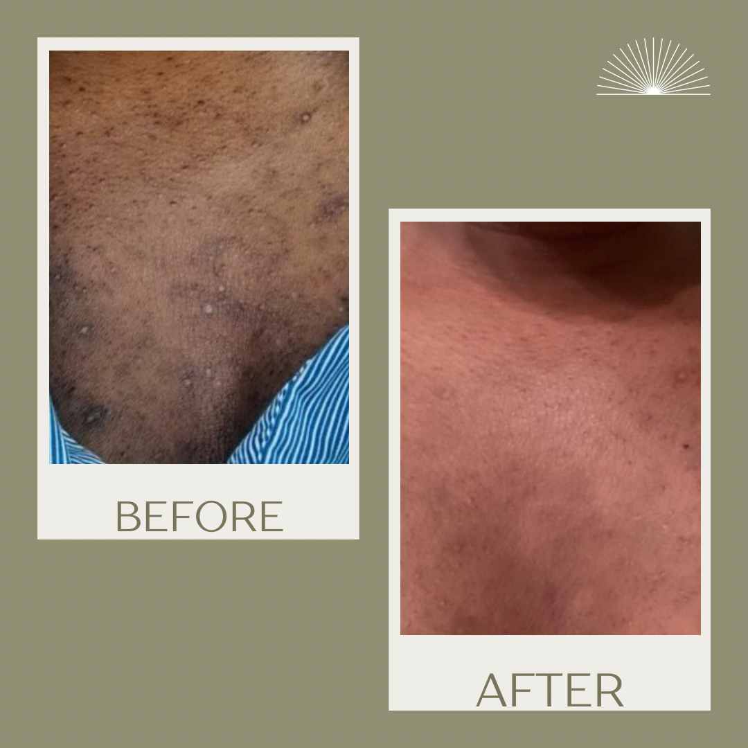 How to Treat Acne Without Harsh Products (Atlanta Guide)