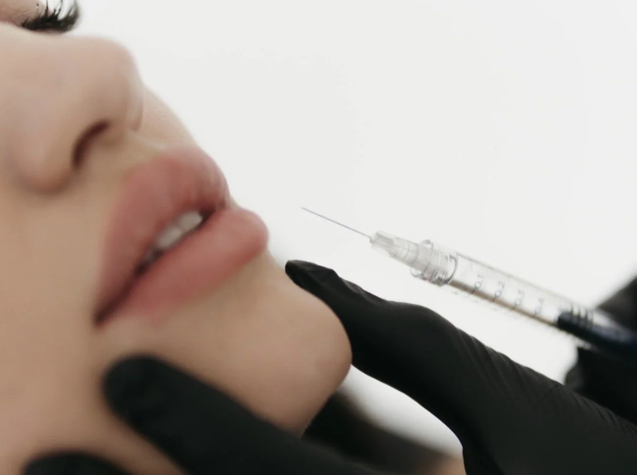 Lip Filler Special