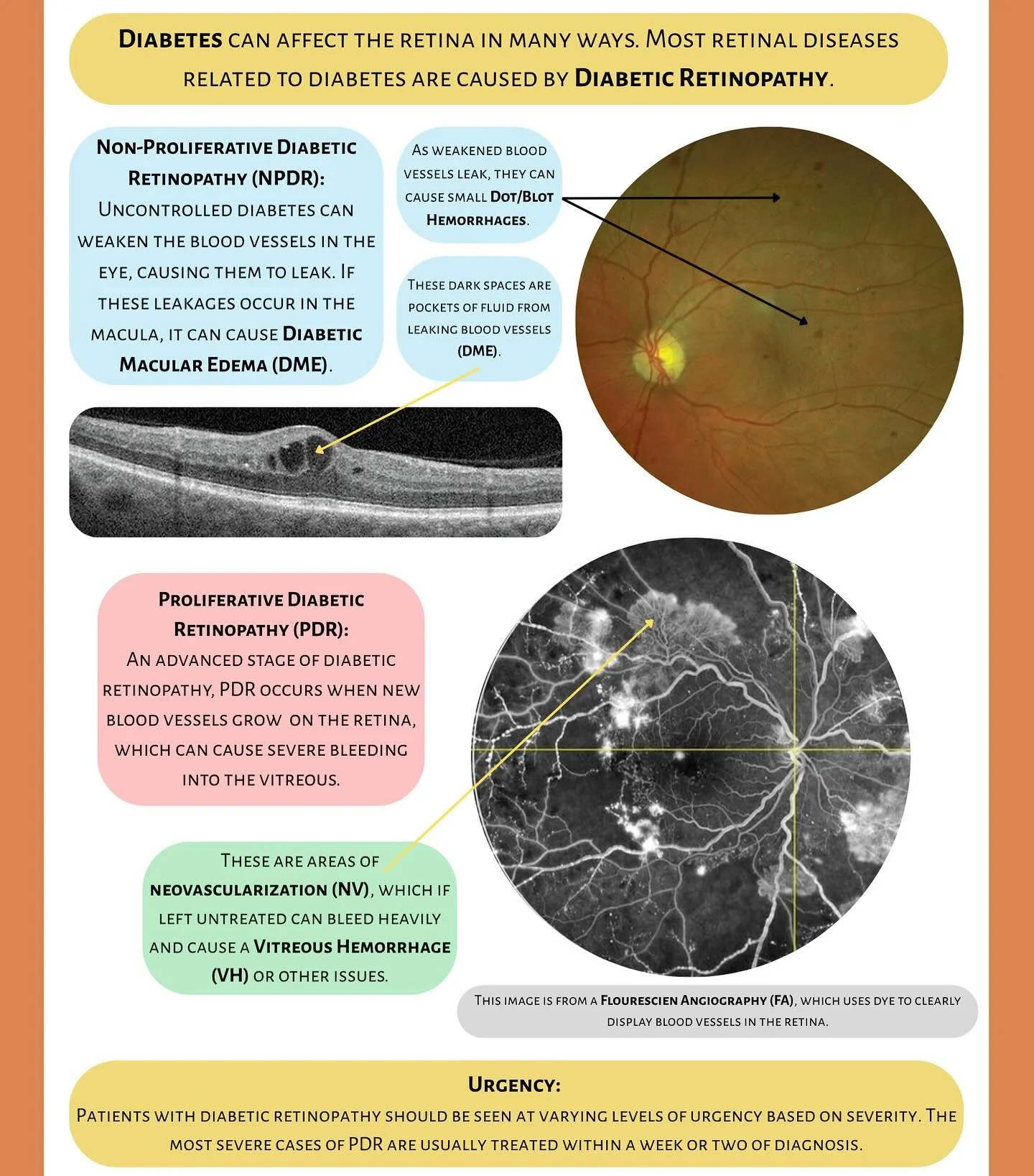 Tuesday Talks🎙️ 

Common Diagnoses 👁️ Diabetic Retinopathy 

Diabetic retinopathy is a complication of diabetes &mdash; damage to the tiny blood vessels in the retina due to high blood sugar levels🩸 The progression can be through two main stages: 