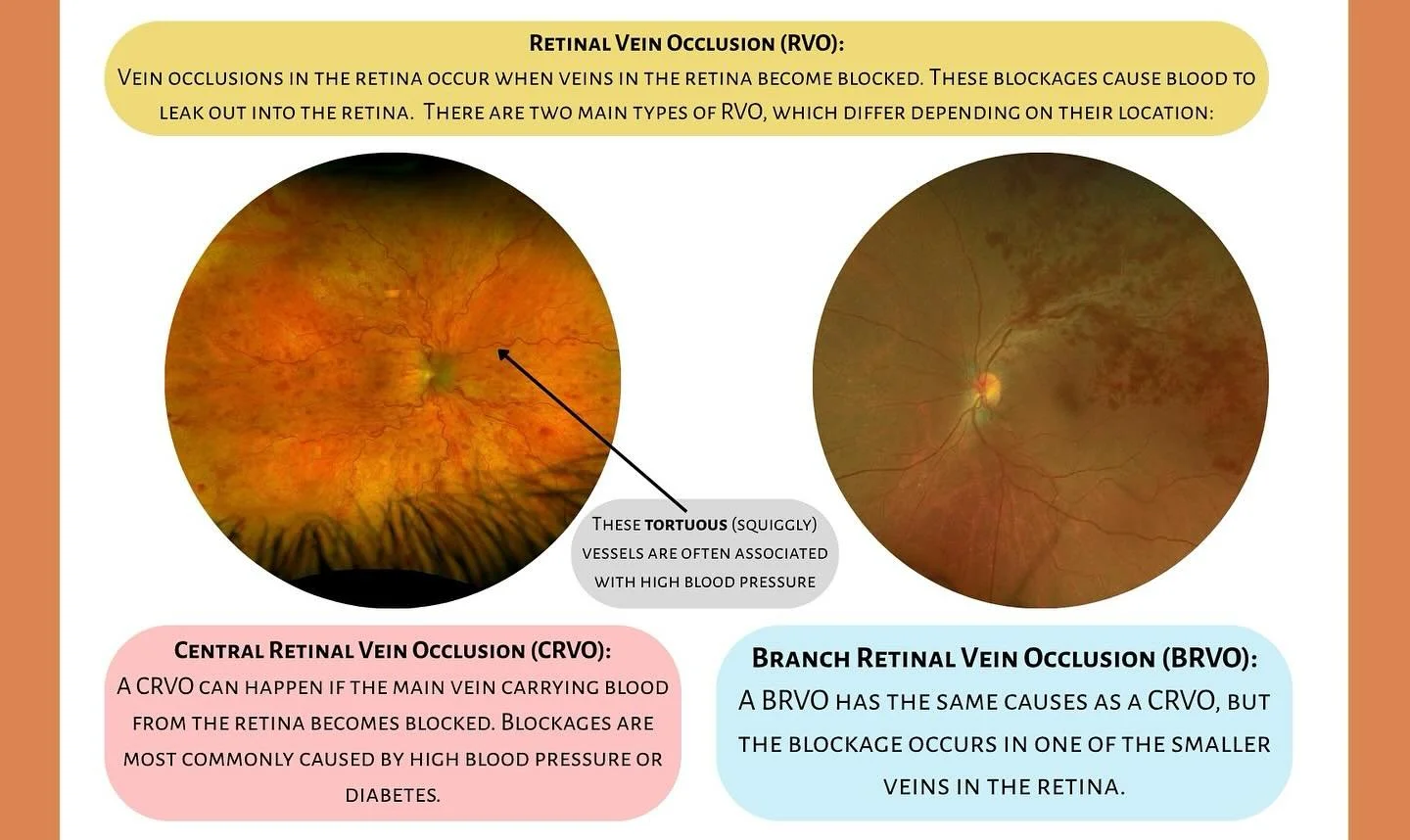 Tuesday Talks🎙️

Commone Diagnoses 👁️ Retinal Vein Occlusion 

What Is Retinal Vein Occlusion (RVO)?
RVO happens when a vein in the retina becomes blocked causing blood and fluid to leak into the retina. Symptoms may include blurry vision or vision