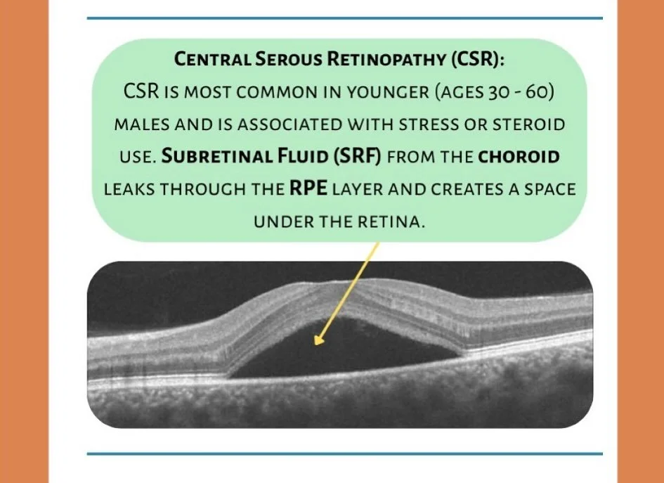 Tuesday Talks🎙️

Commone Diagnoses👁️Central Serous Retinopathy (CSR)
 It&rsquo;s an eye condition where fluid builds up under the retina &mdash; originated from leak in the choroid. 
 💭Most commonly affects young to middle-aged males, and linked t