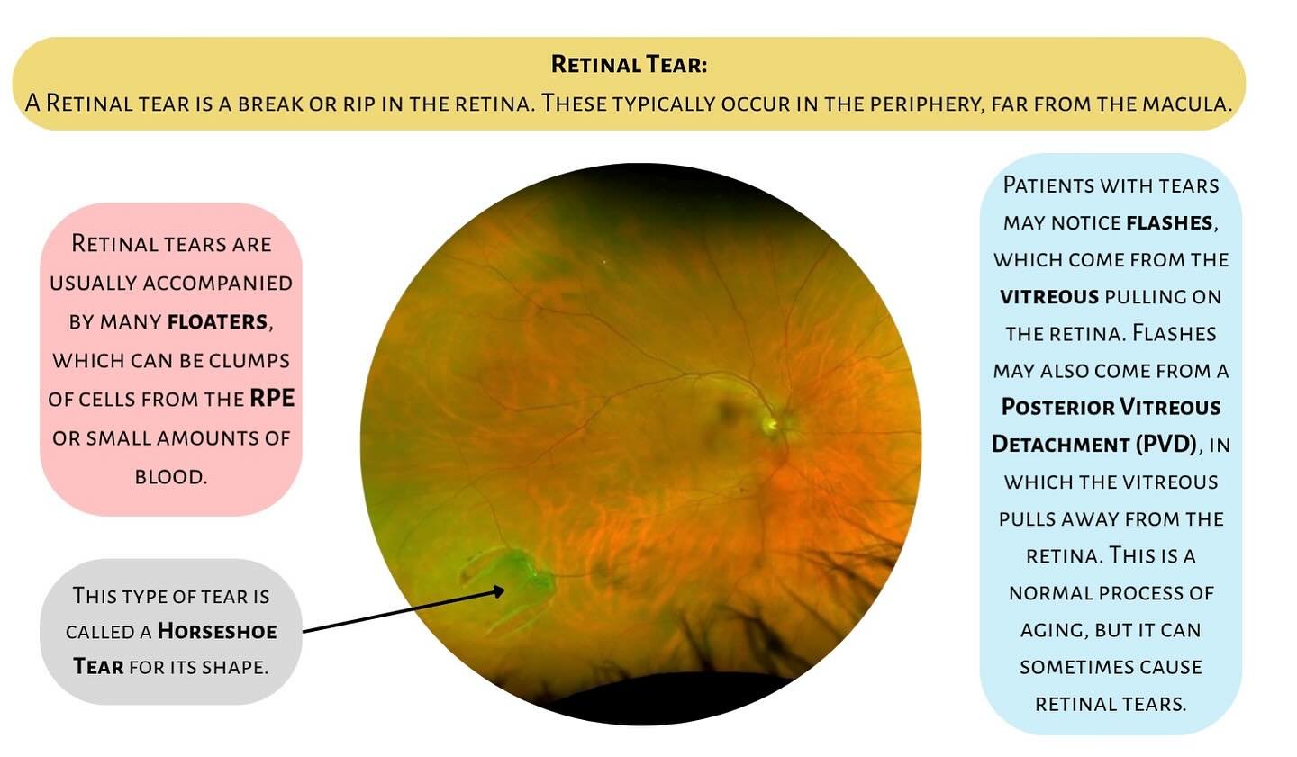 Tuesday Talks🎙️

Commone Diagnoses 👁️ Retinal Tears 
 A retinal tear is a small break in the thin tissue lining the back of your eye. Most tears occur in the peripheral retina, often after the vitreous gel pulls away as we age.

Common Symptoms Inc