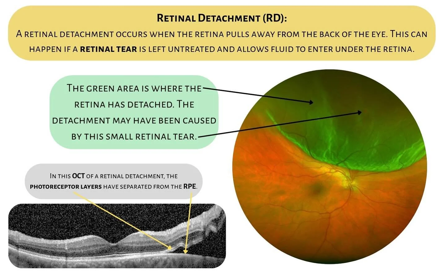 Tuesday Talks🎙️

Commone Diagnoses 👁️ Retinal Detachment 

A retinal detachment is an eye emergency where the retina pulls away from the back of the eye. Without quick treatment, it can lead to permanent vision loss. 

Symptoms to Watch For: 
✅Sudd