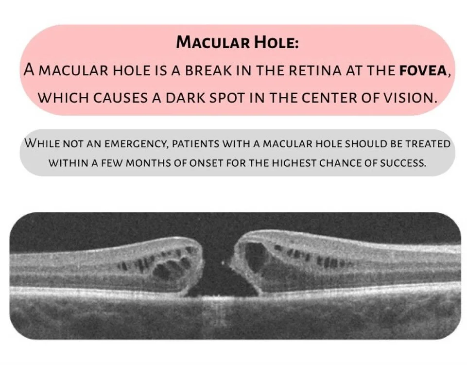 Tuesday Talks🎙️

Commone Diagnoses 👁️ Macular Hole 

A macular hole is a small break in the retina at the fovea, the part of the eye responsible for sharp, central vision.

Common Symptoms
* Blind or blurry spot right in the center 
* Blurry vision