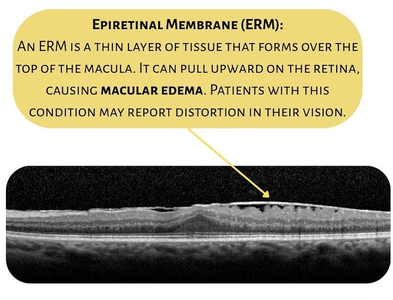 Tuesday Talks🎙️

Common Diagnoses 👁️ Epiretinal Membrane 

An epiretinal membrane (or macular pucker) is a thin layer of scar-like tissue that forms on the surface of the retina &mdash; causing the retina to wrinkle or contract.

Common Symptoms
➡️