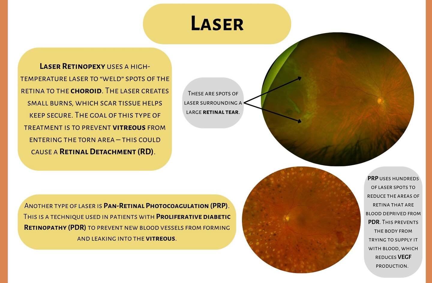 Tuesday Talks🎙️

Treatment Options 👁️ Laser 

Laser procedures play an important role in protecting vision and preventing serious retinal problems. Here&rsquo;s a quick breakdown of the main types shown above 👇

⚡️Laser Retinopexy Used for retinal