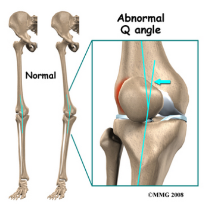 What is knee valgus and should we be worried about&nbsp;it?</a>