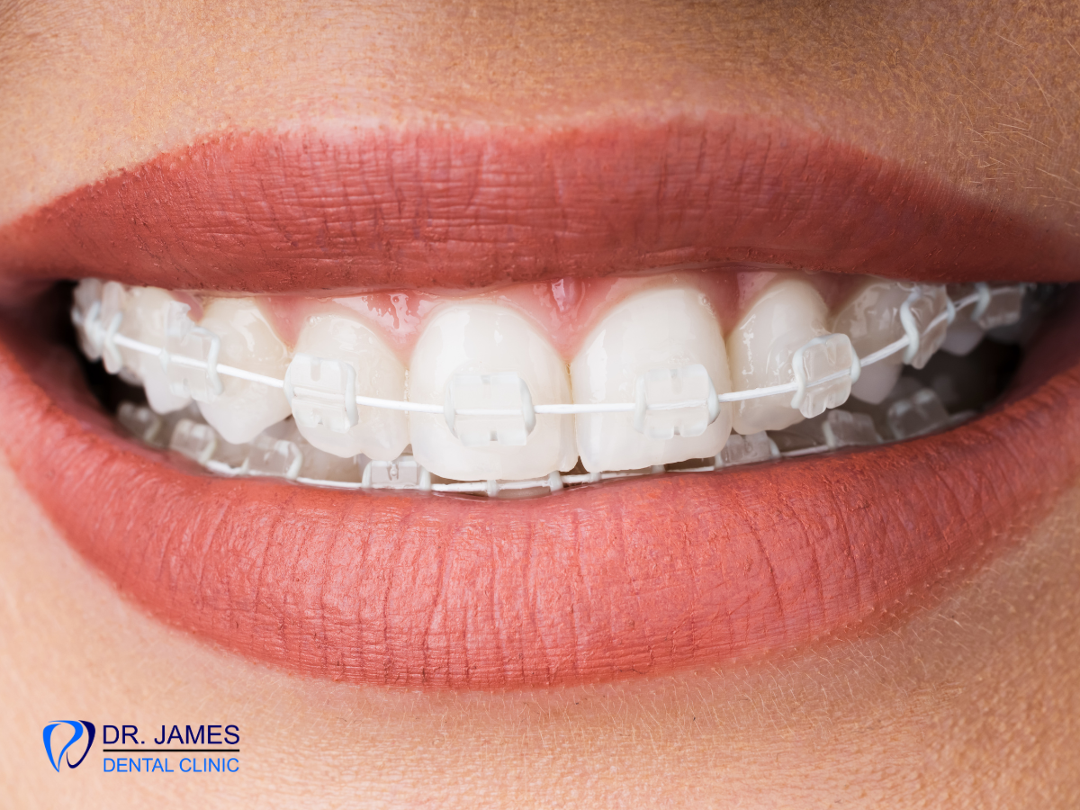 ceramic braces.png
