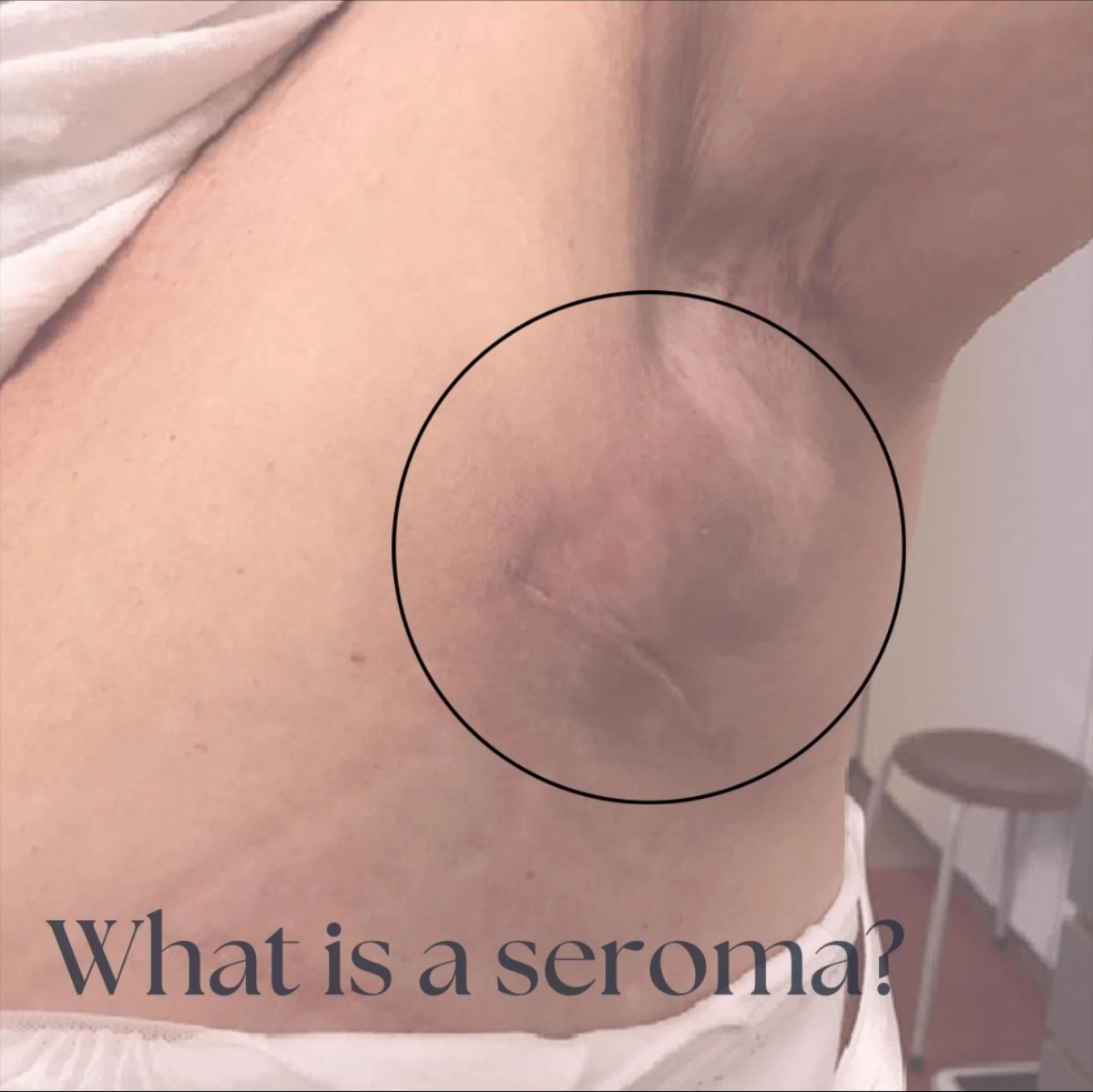 A seroma is a common complication following breast cancer surgery where fluid collects under the skin at the surgical site. It usually happens after surgeries like mastectomy (removal of the breast tissue) or lumpectomy (removal of a tumor and some s