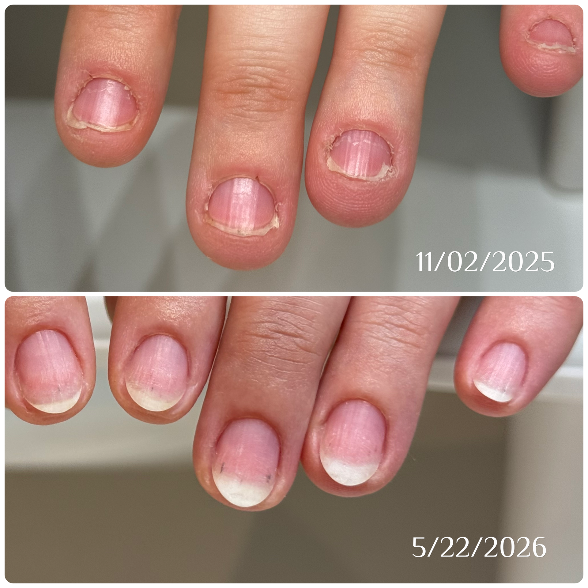 Before and after protective gel care, showing natural nails transforming from brittle nails into strong, healthy nails.
