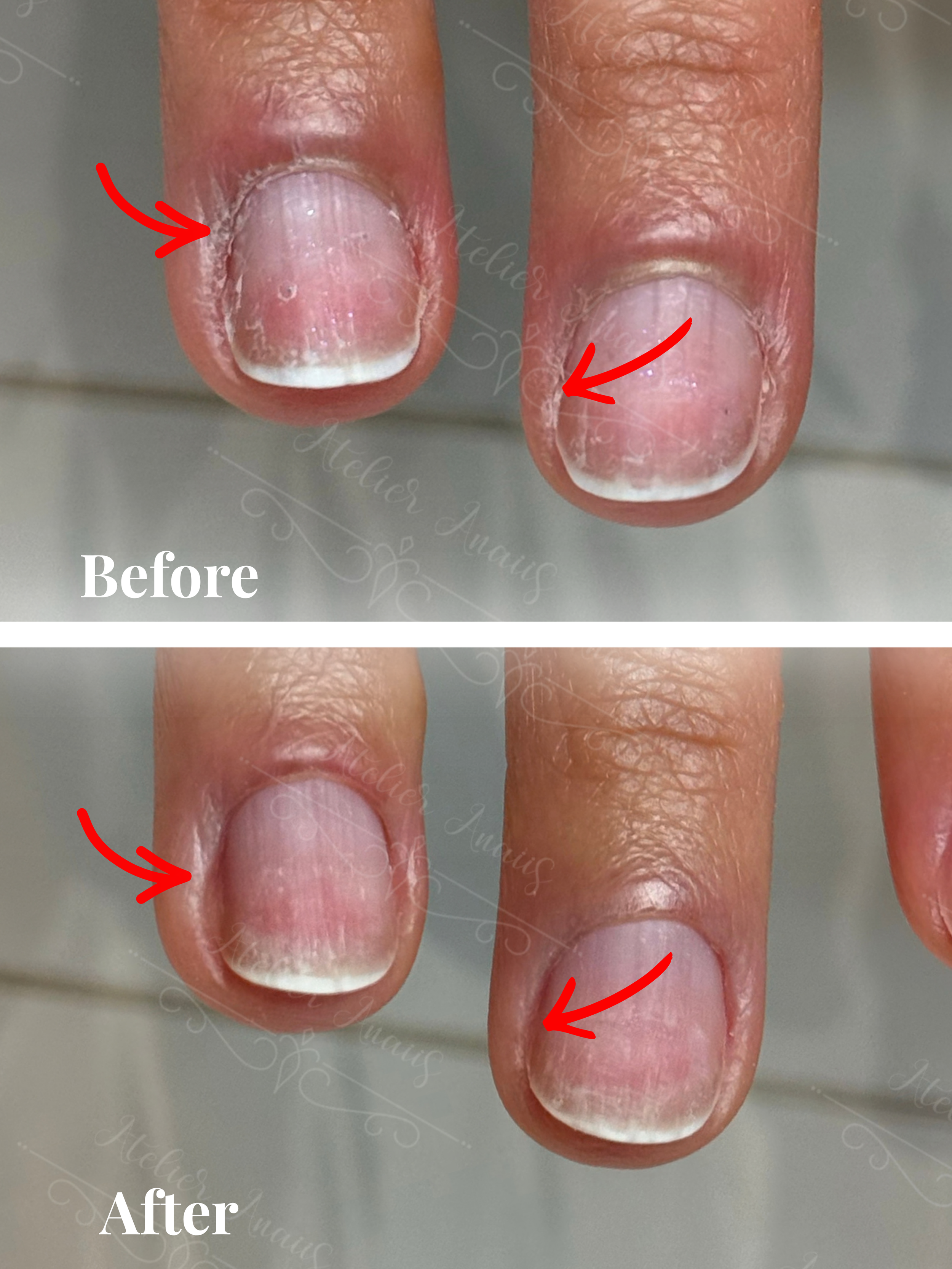 Before/after photo showing Atelier Anaiis treatments to smooth the skin surrounding the nails.