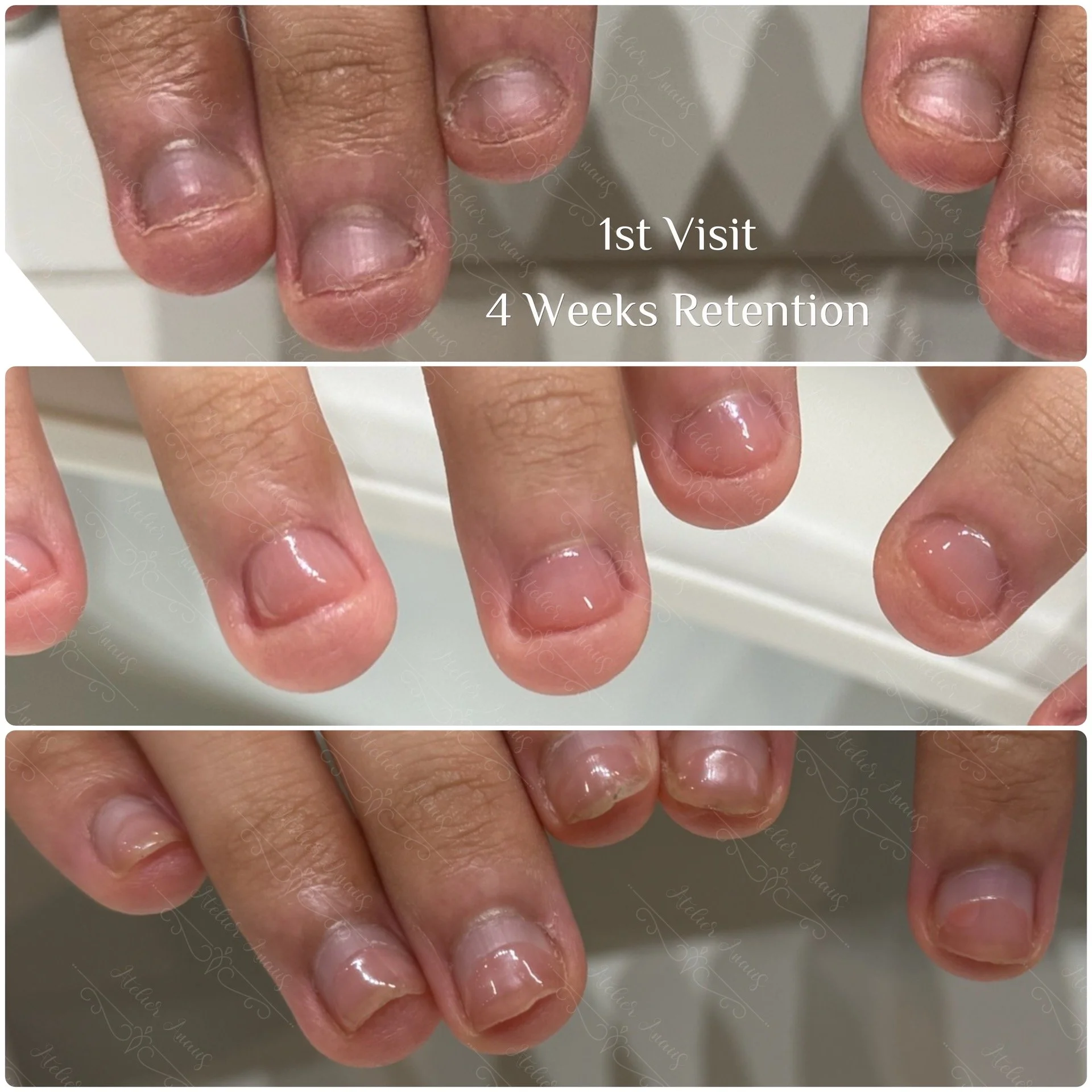 Nail Biting Recovery Before and After: Real Results from Healing Damaged Nails