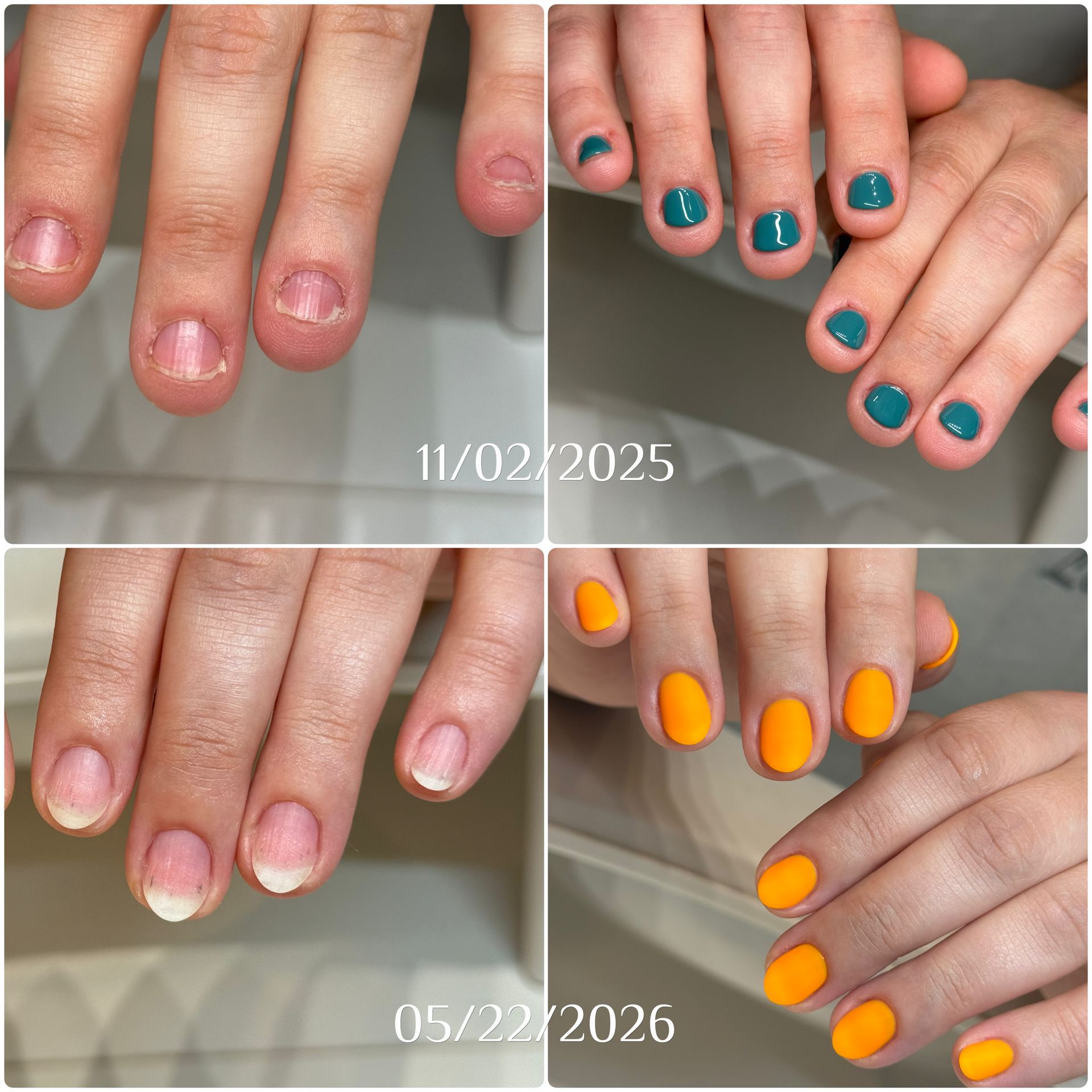 Before and after photo of protective gel care over six months at Atelier Anaiis, showing short, brittle nails transforming into beautiful, strong nails.