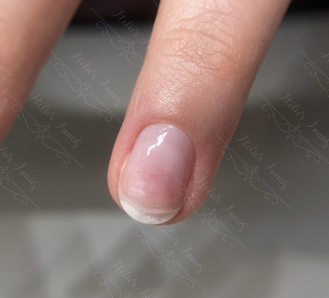 Ring of fire on a nail, bruising from e-file use.