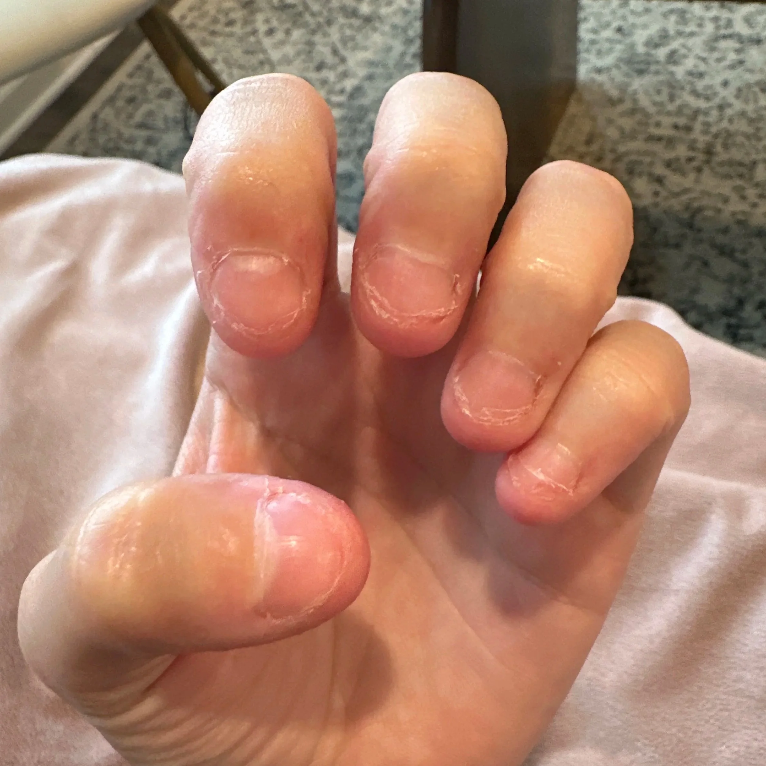 8 Mistakes That Slow Nail Biting Recovery