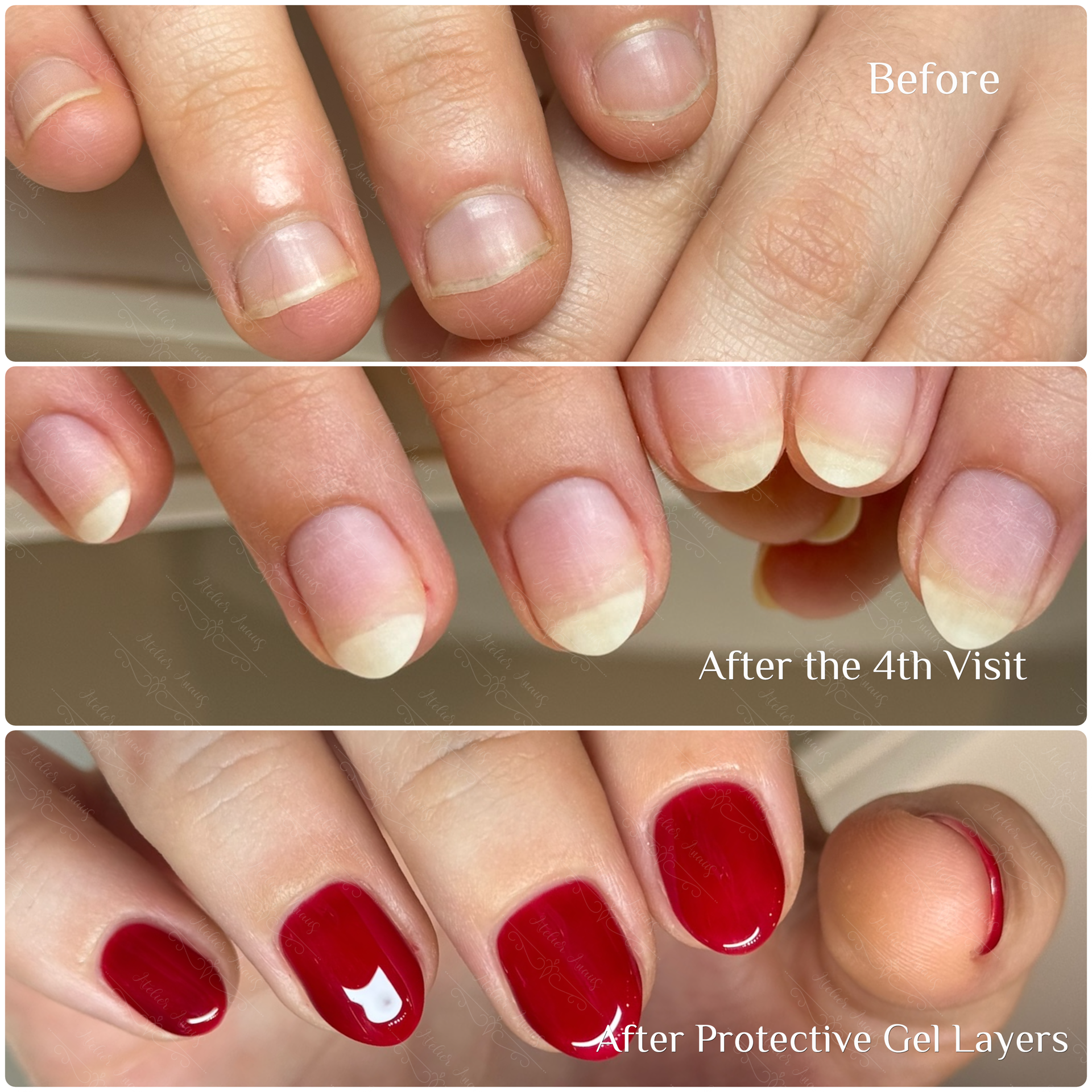 A stunning transformation of a nail biting recovery client's nails, from short and damaged to long and strong. At Atelier Anaiis, a nail care studio in Philadelphia.