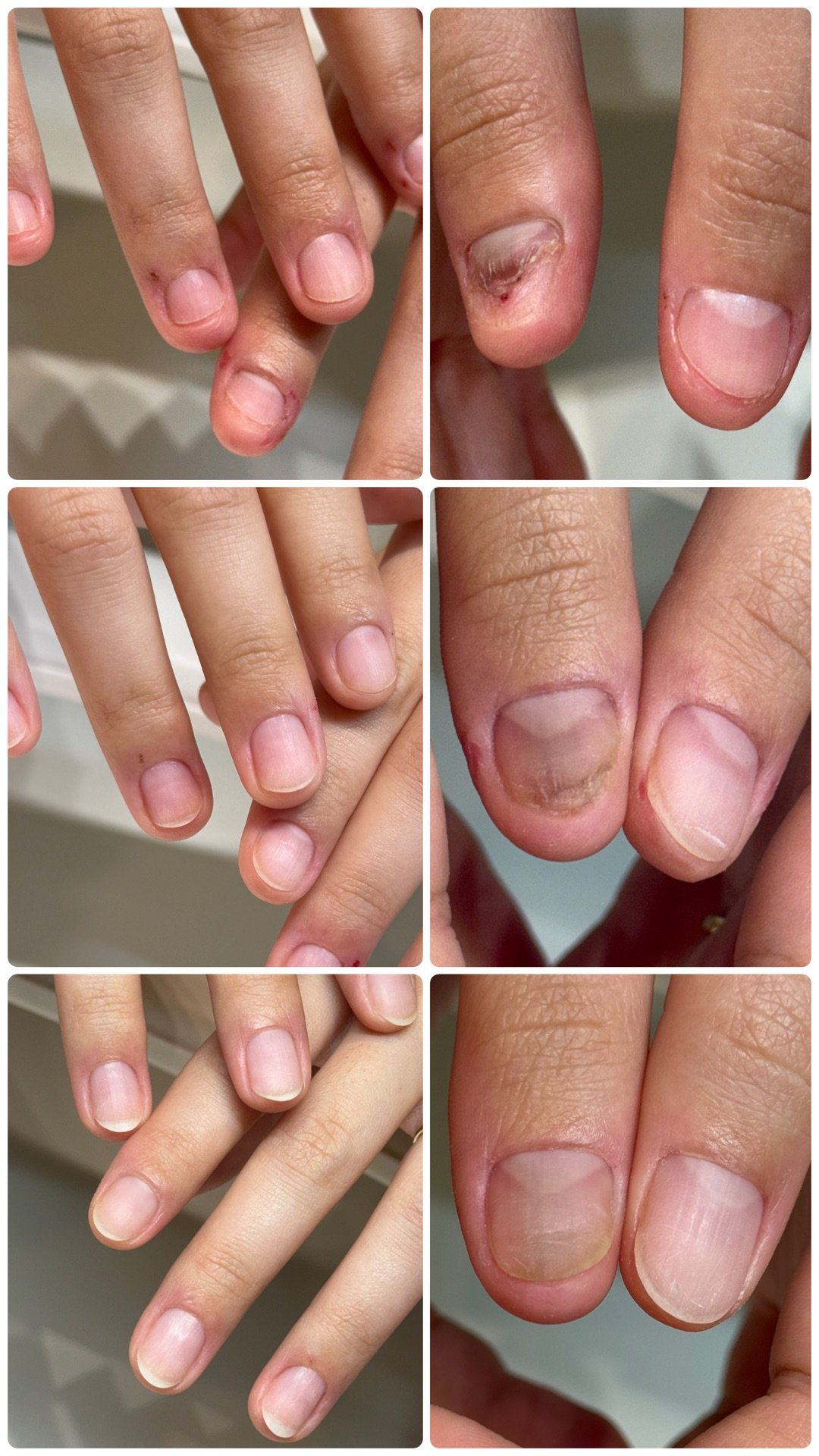 Before and after nail biting recovery photo, showing the progression of growth from having many hangnails and damaged, short nails before to the nails growing strong and hangnails disappearing.