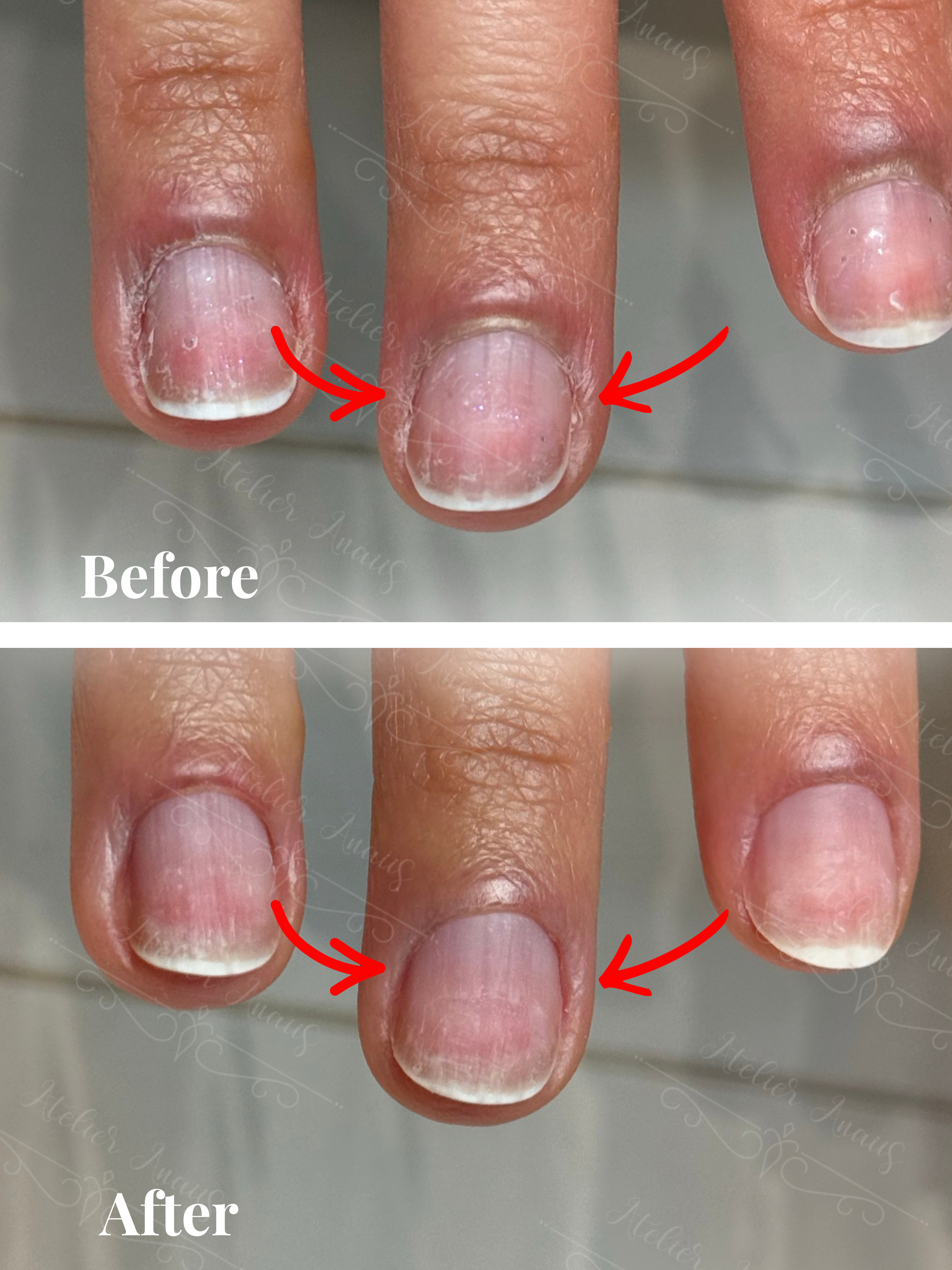 A before/after photo showing jagged, overgrown skin being removed to become smooth skin.