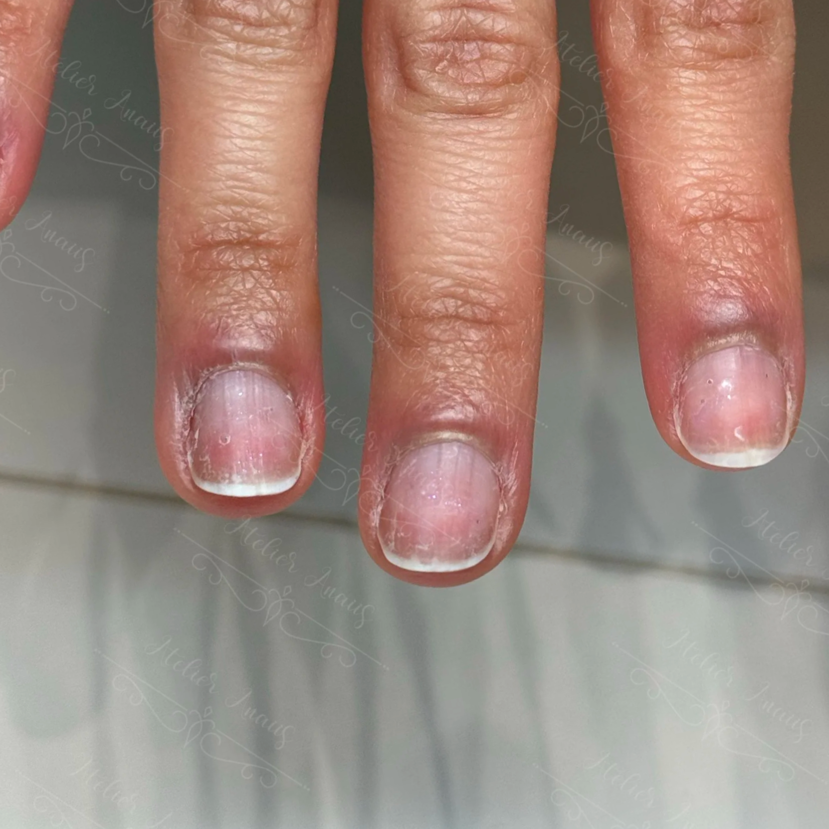 Before nail biting recovery at Atelier Anaiis, showing bitten nails with jagged skin and heavy bruising.