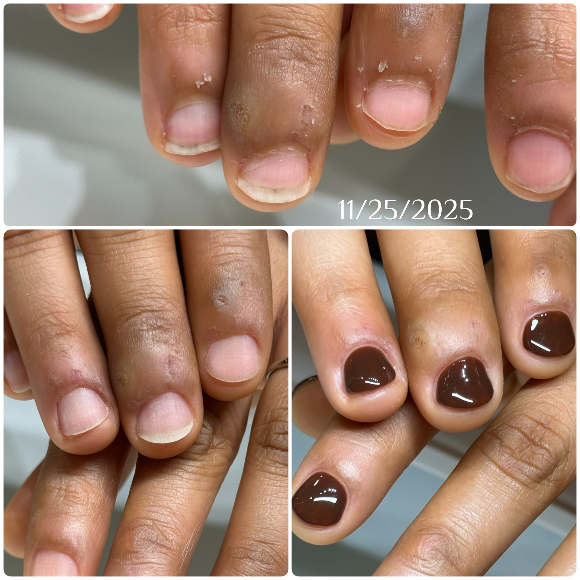 Before protective gel care at Atelier Anaiis, showing a hand with lots of hangnails, short nail beds, and overgrown eponychium.
