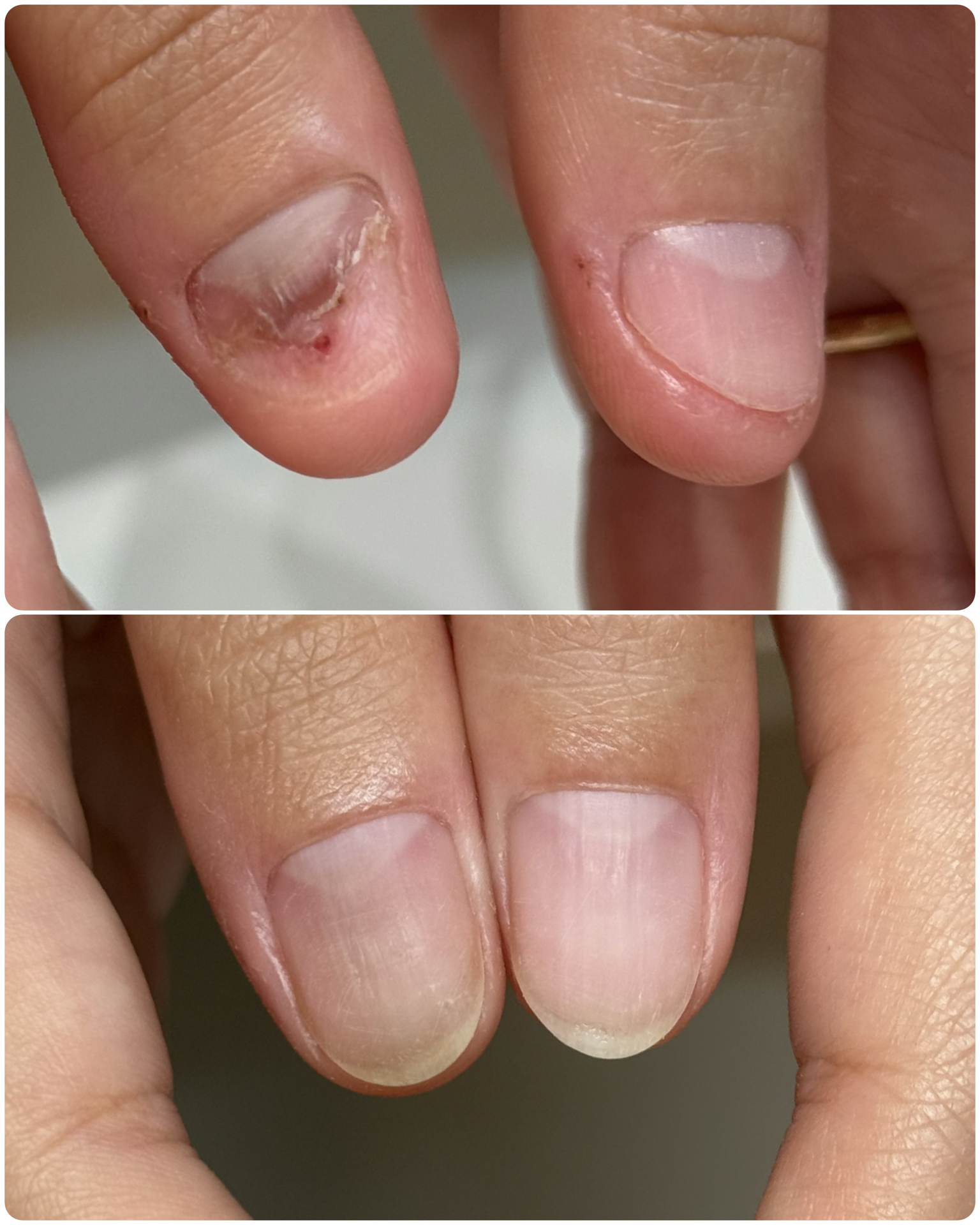 Before after photo of nail biting recovery, showing severe case of nail biting with raw nail bed before, followed by regrowth of nail after, at Atelier Anaiis.