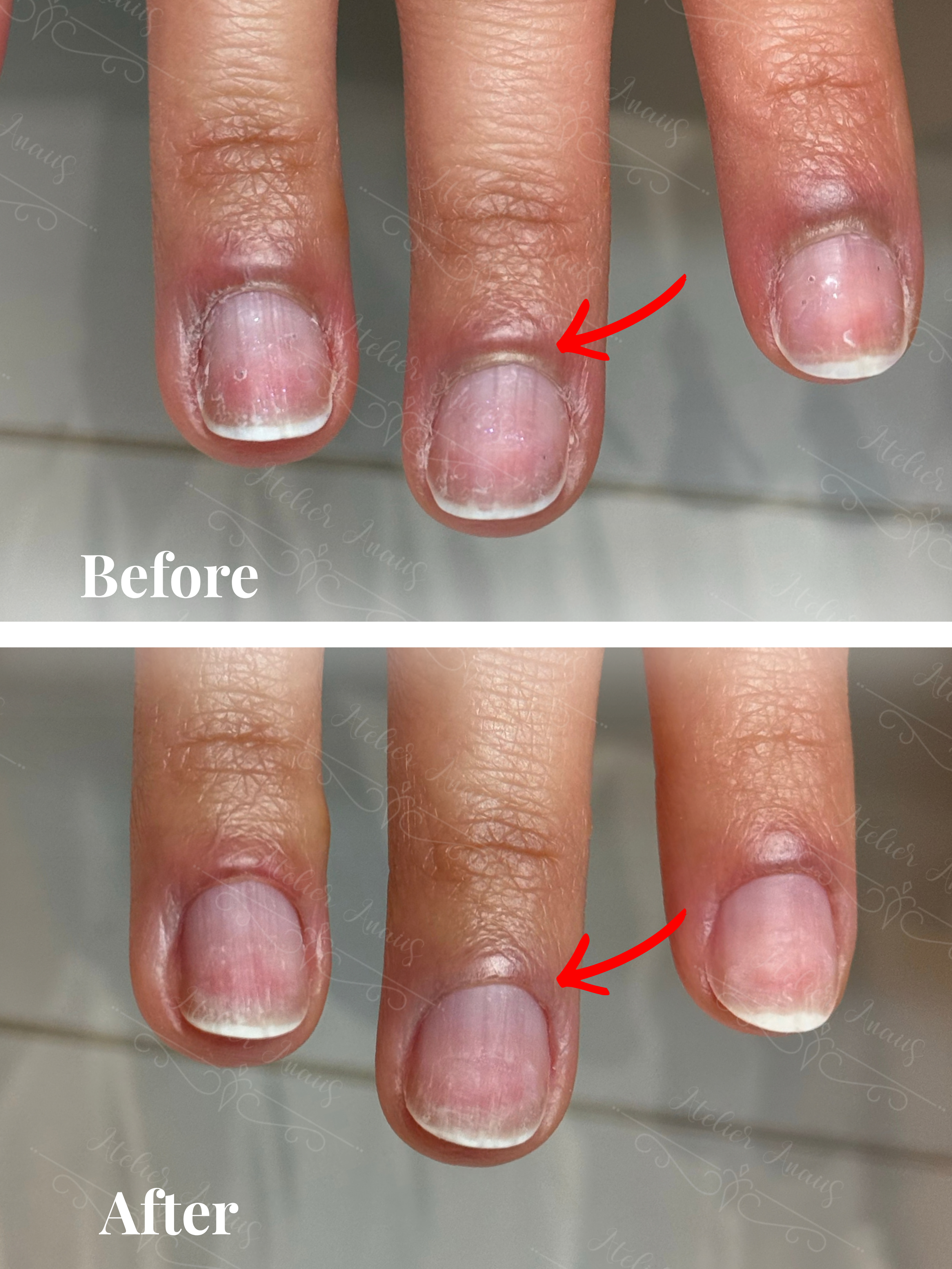 A before/after photo showing thick, unmanaged eponychium being treated and thinned.