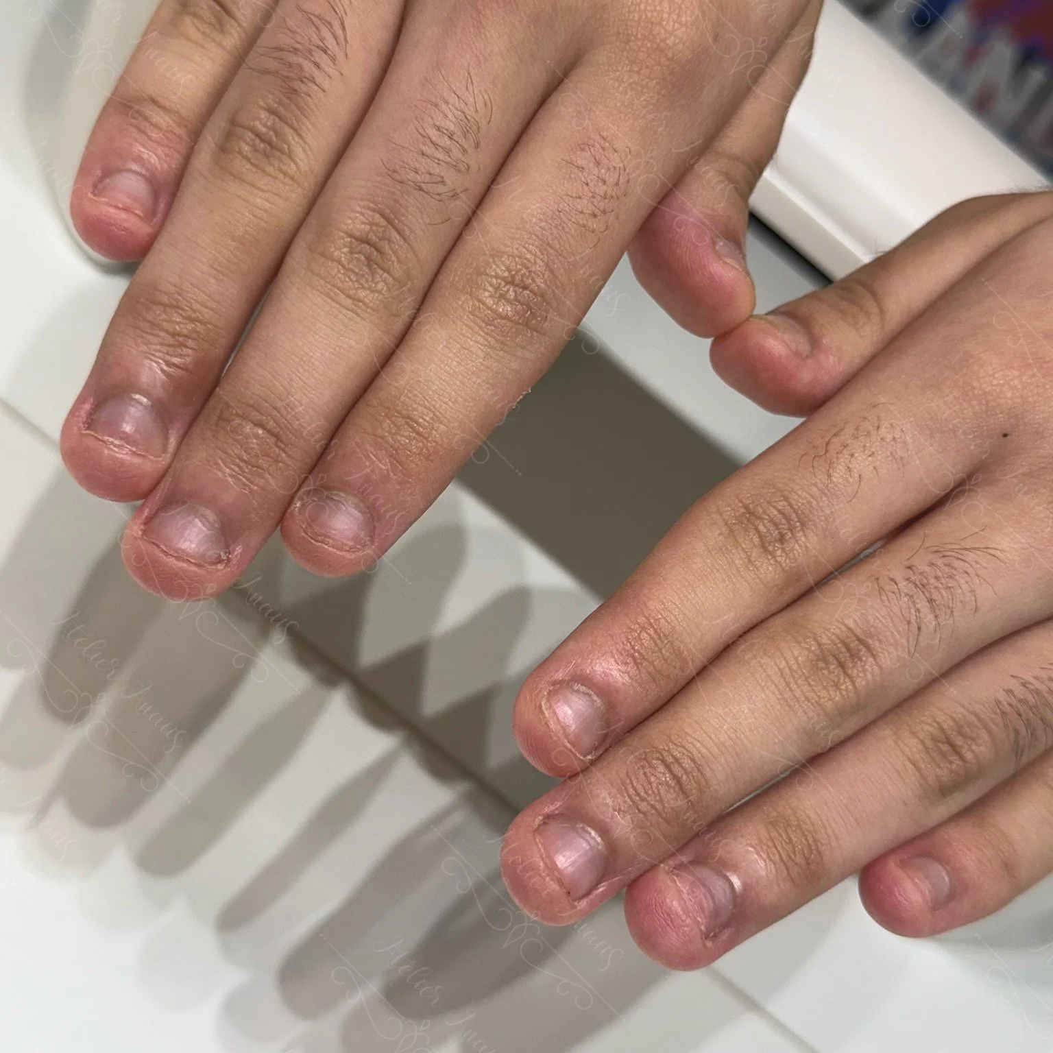 A nail biting recovery client at Atelier Anaiis, with extremely short nail plates, overgrown eponychium, and detached hyponychium.