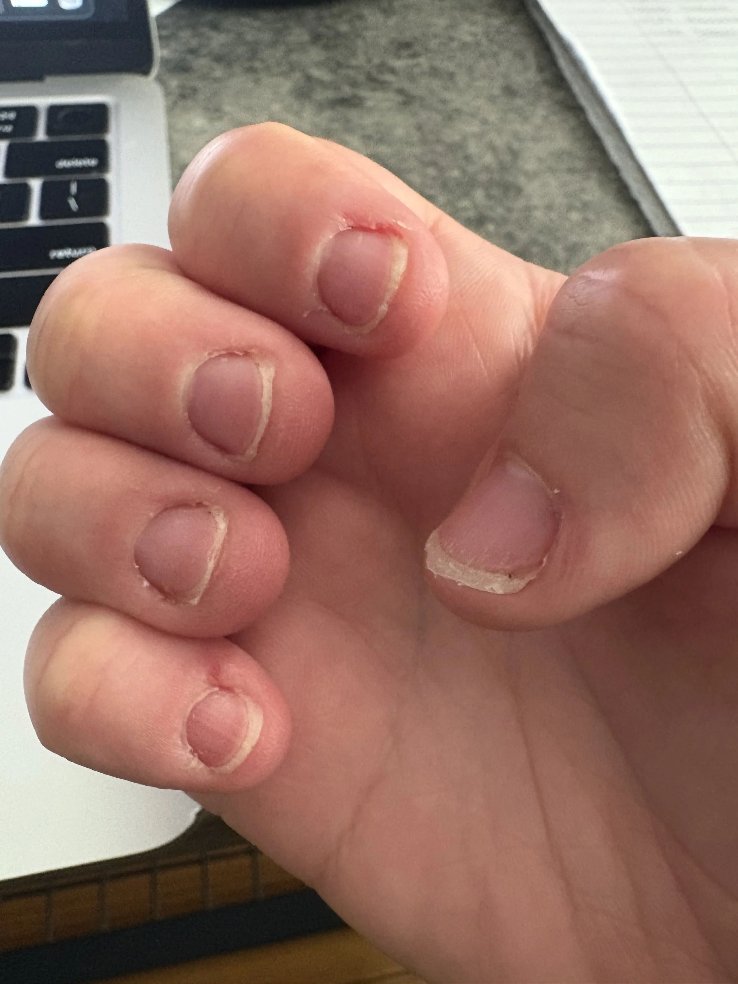 Before protective gel care, showing brittle, thin nails and hangnails.