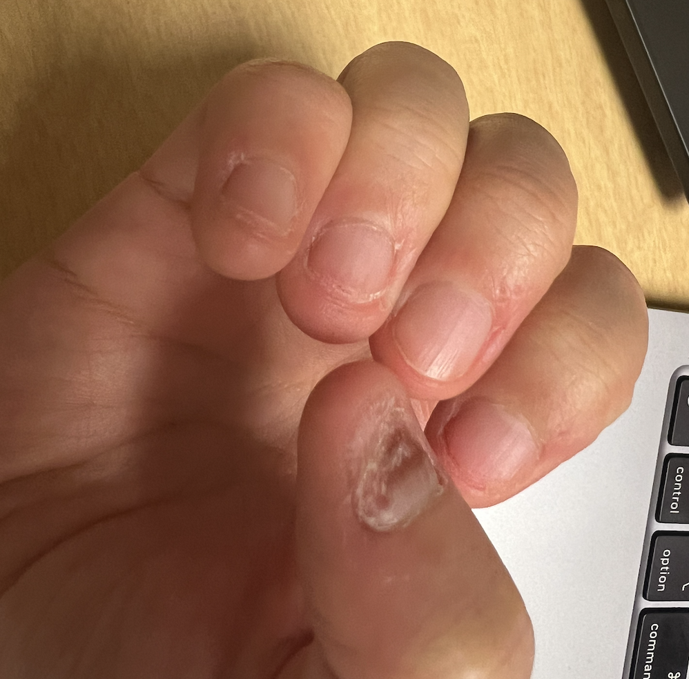 Short, raw, nails from nail biting, with thumb nails mostly chewed off.