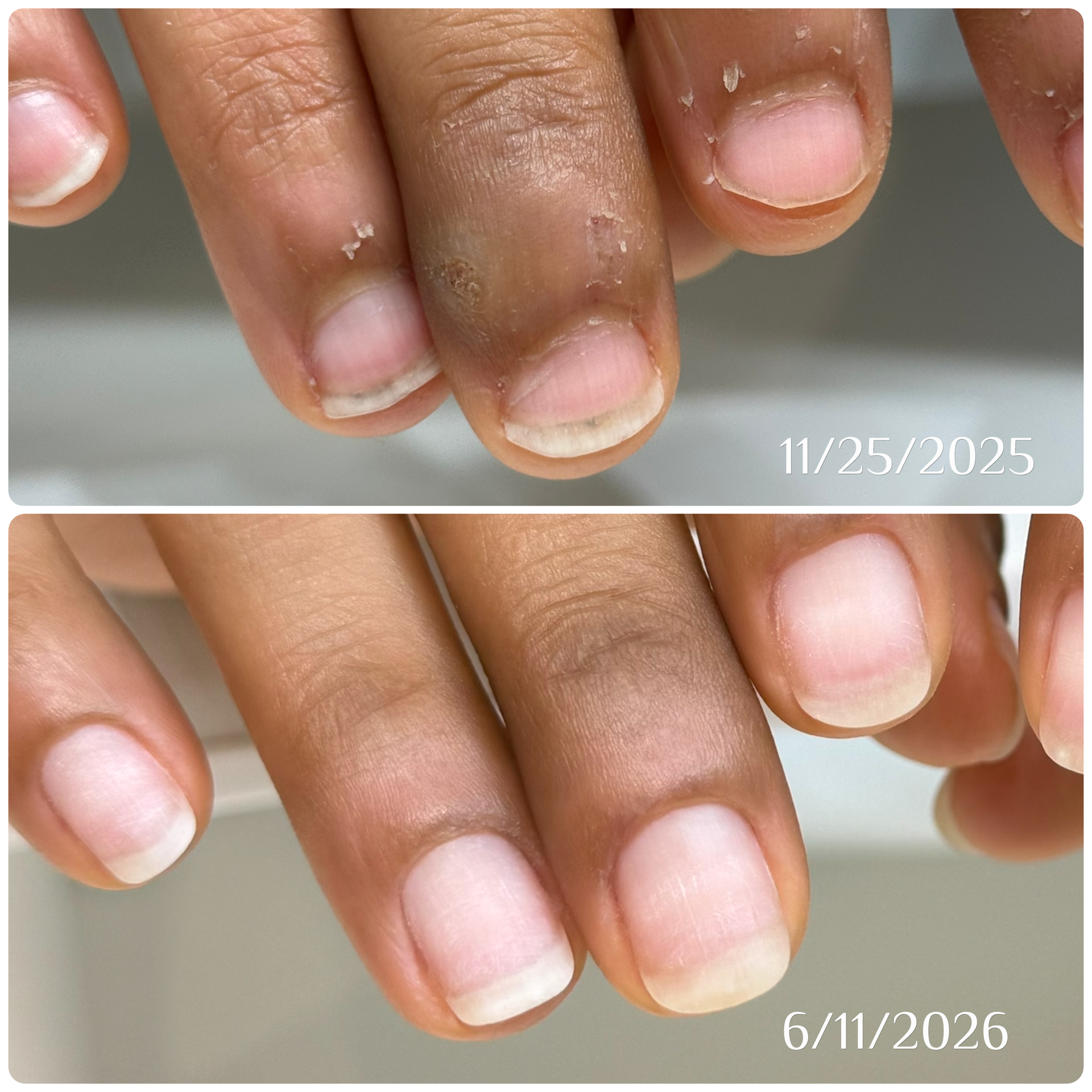Before and after restorative nail care at Atelier Anaiis. The hand transforms from having shrinking nail beds, lots of hangnails, and overgrown eponychium, to a model of healthy and long nails.