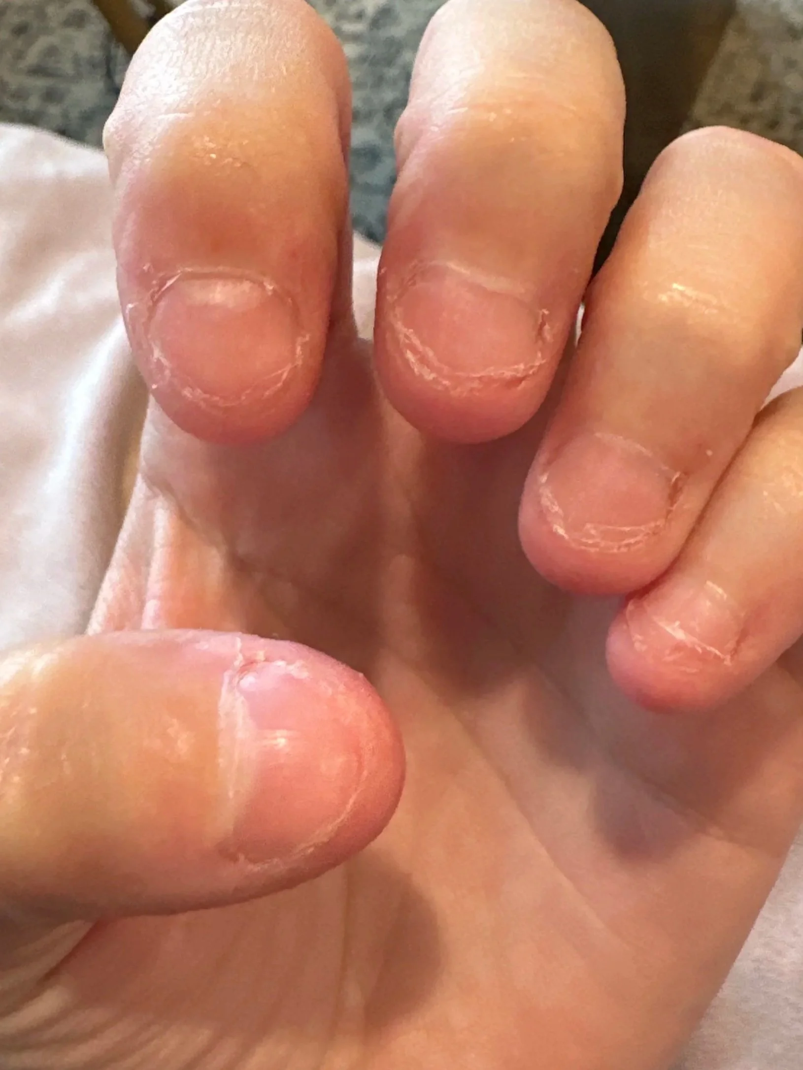 A long time nail biter with detached hyponychium, overgrown eponychium, short nail plates, and lots of hangnails.