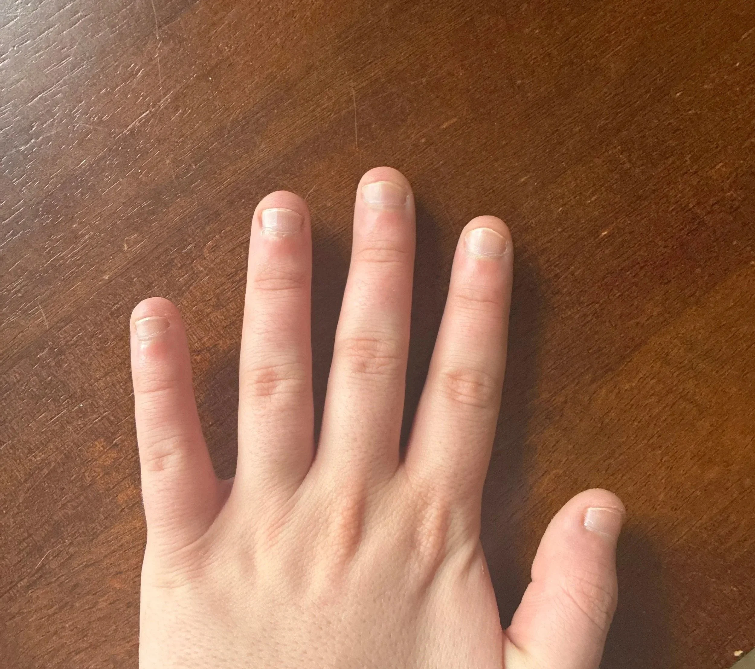 Before nail biting recovery at Atelier Anaiis, showing extremely short, bitten nails with swollen nail walls.
